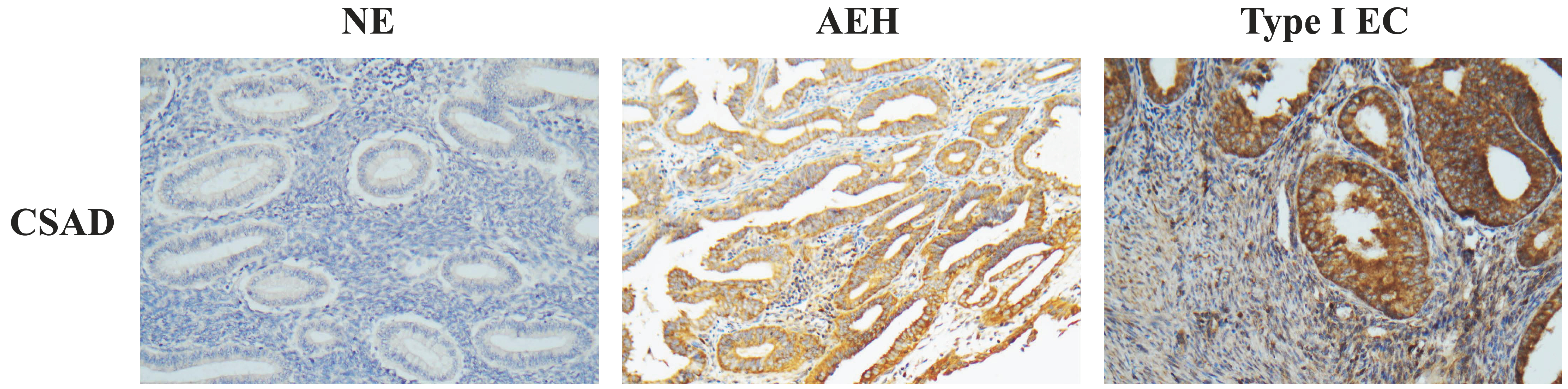 Representative immunohistochemical staining showing CSAD
expression in normal endometrium (NE), Atypical endometrial hyperplasia (AEH) and
Type I Endometrial carcinoma (Type I EC) tissues using serial section technique.
Increased CSAD expression was observed in one representative case with type I EC.
Magnifications, ×200. CSAD, Cysteine sulfinate decarboxylase.