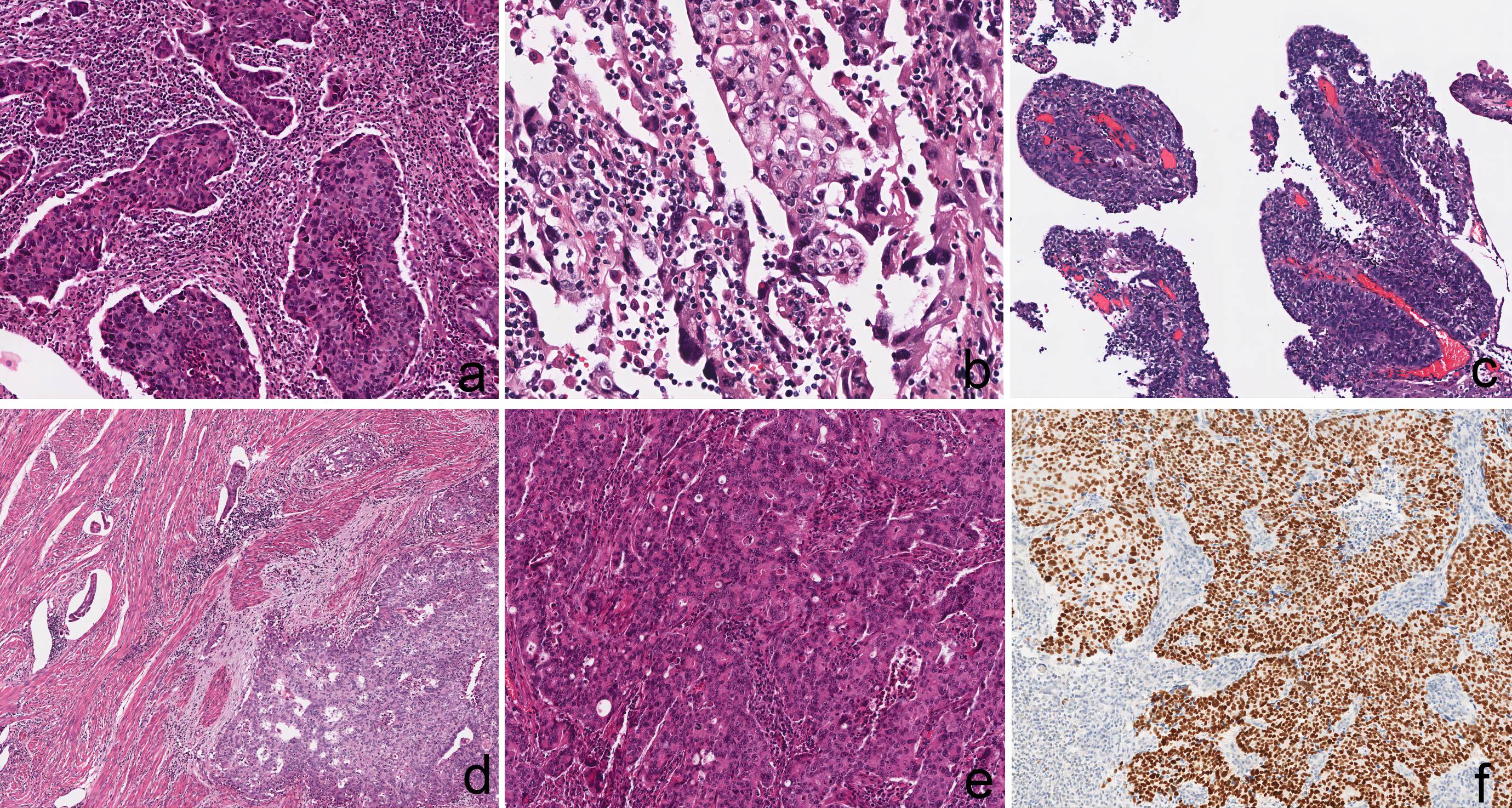 G3-EECs. (a) Peritumoral lymphocyte infiltration
(×200), (b) bizarre atypia (×400), (c) tumor cell growth around
vessels (×100), (d) deep myometrial invasion and LVSI (×100),
(e,f) the same case displayed with solid architecture and abnormal staining
of p53 (×200), (f) p53 staining was diffused positive. Abbreviations:
G3-EEC, grade 3 endometrioid endometrial carcinoma; LVSI, lymphovascular space
invasion.