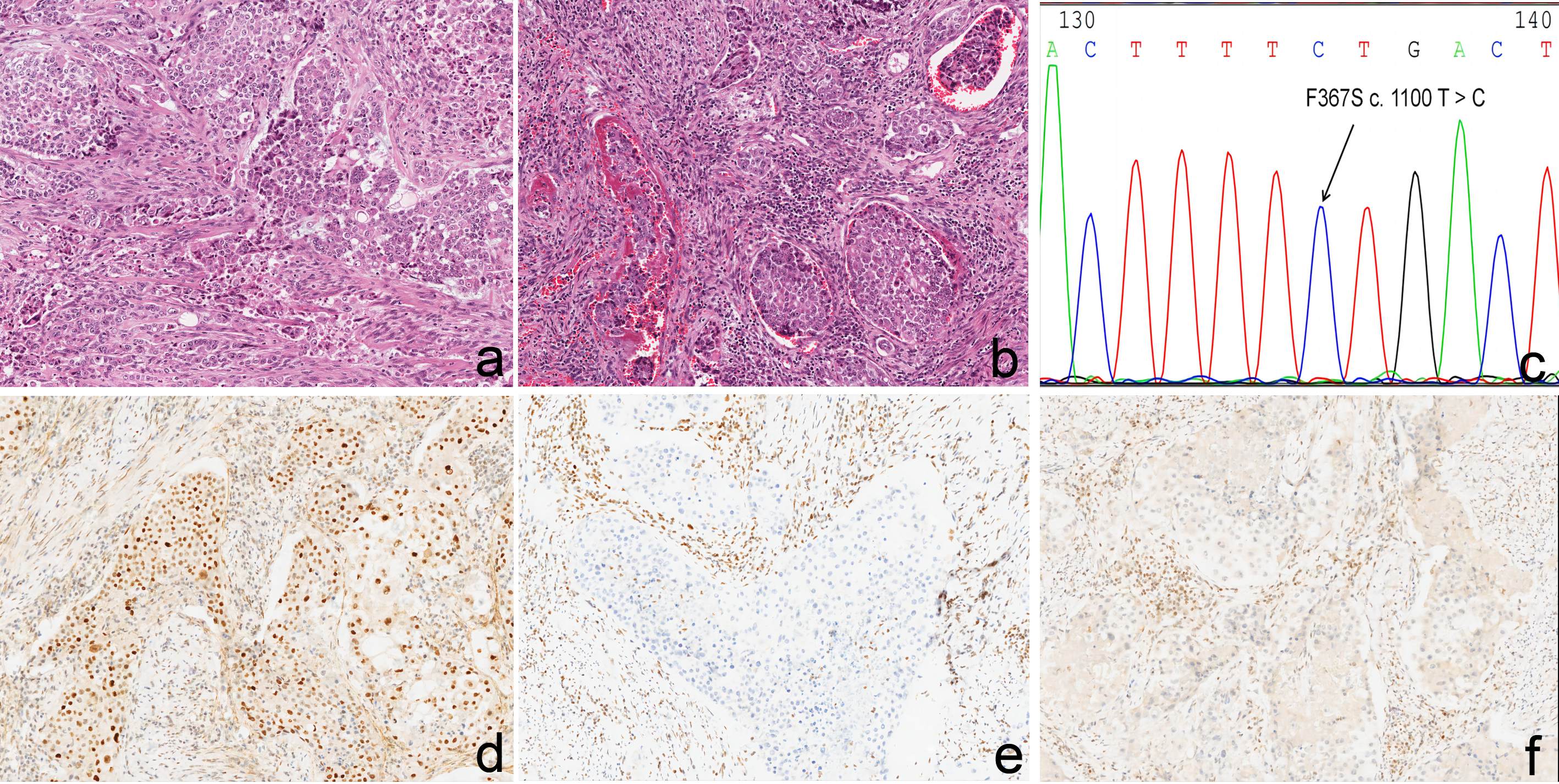 A multi-classifier case of G3-EEC. (a) Poorly differentiated tumor cells (×200), (b) LVSI (×200), (c)
POLEmut (F367S), (d) diffuse positive staining for p53, (e) loss of staining for MLH1, (f) loss of staining for PMS2 (×200). Abbreviation: G3-EEC, grade 3 endometrioid endometrial carcinoma; LVSI, lymphovascular space
invasion.