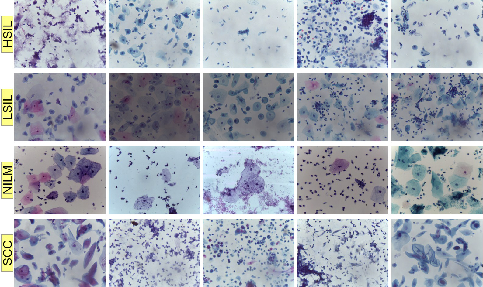 Sample images for each class in the Mendeley LBC dataset. HSIL:
High-grade Squamous Intraepithelial Lesion; LSIL: Low-grade Squamous
Intraepithelial Lesion; NILM: Negative for Intraepithelial Lesion or Malignancy;
SCC: Squamous Cell Carcinoma.