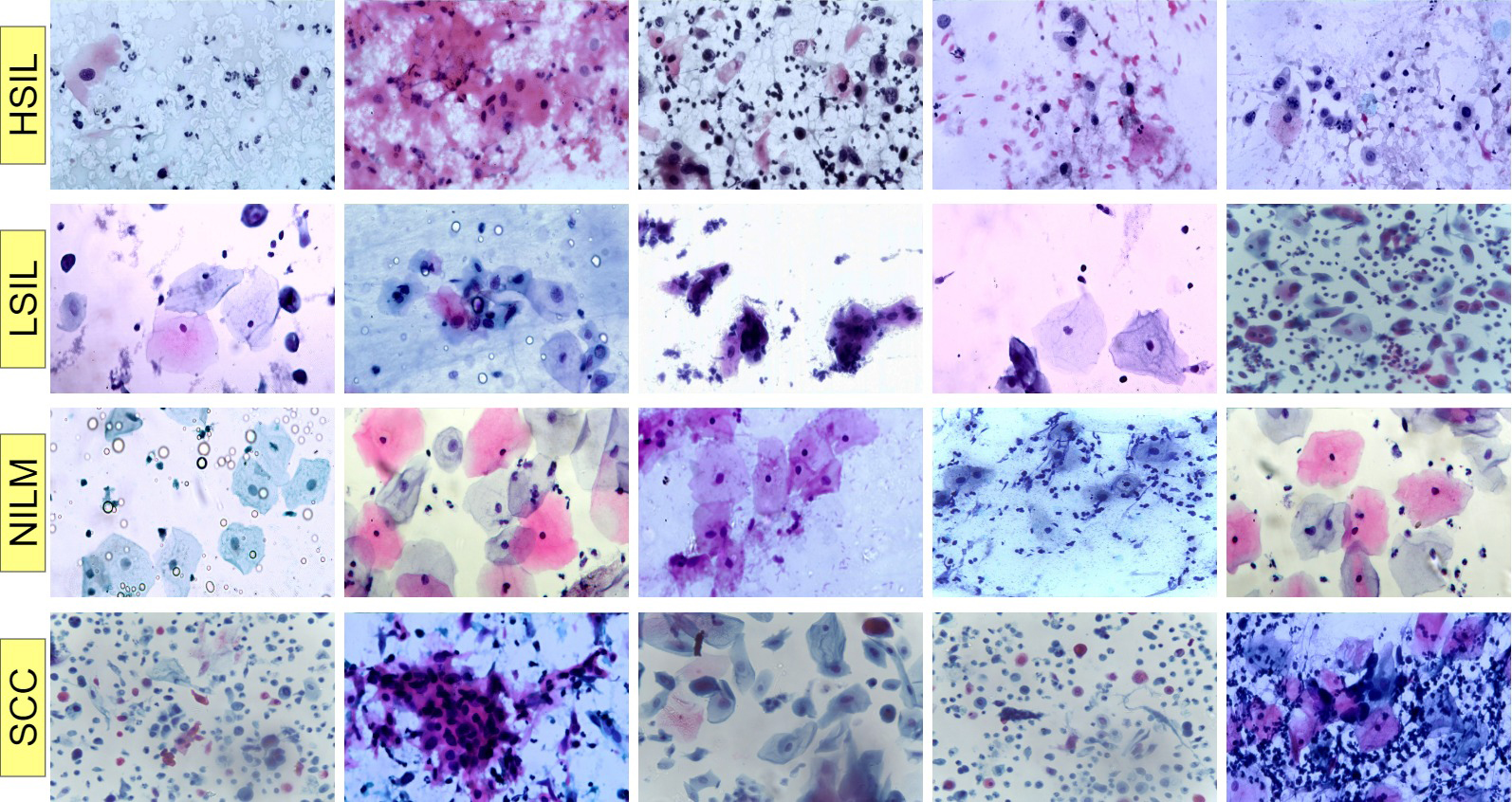 Sample images for each class in the Malhari dataset. HSIL:
High-grade Squamous Intraepithelial Lesion; LSIL: Low-grade Squamous
Intraepithelial Lesion; NILM: Negative for Intraepithelial Lesion or Malignancy;
SCC: Squamous Cell Carcinoma.