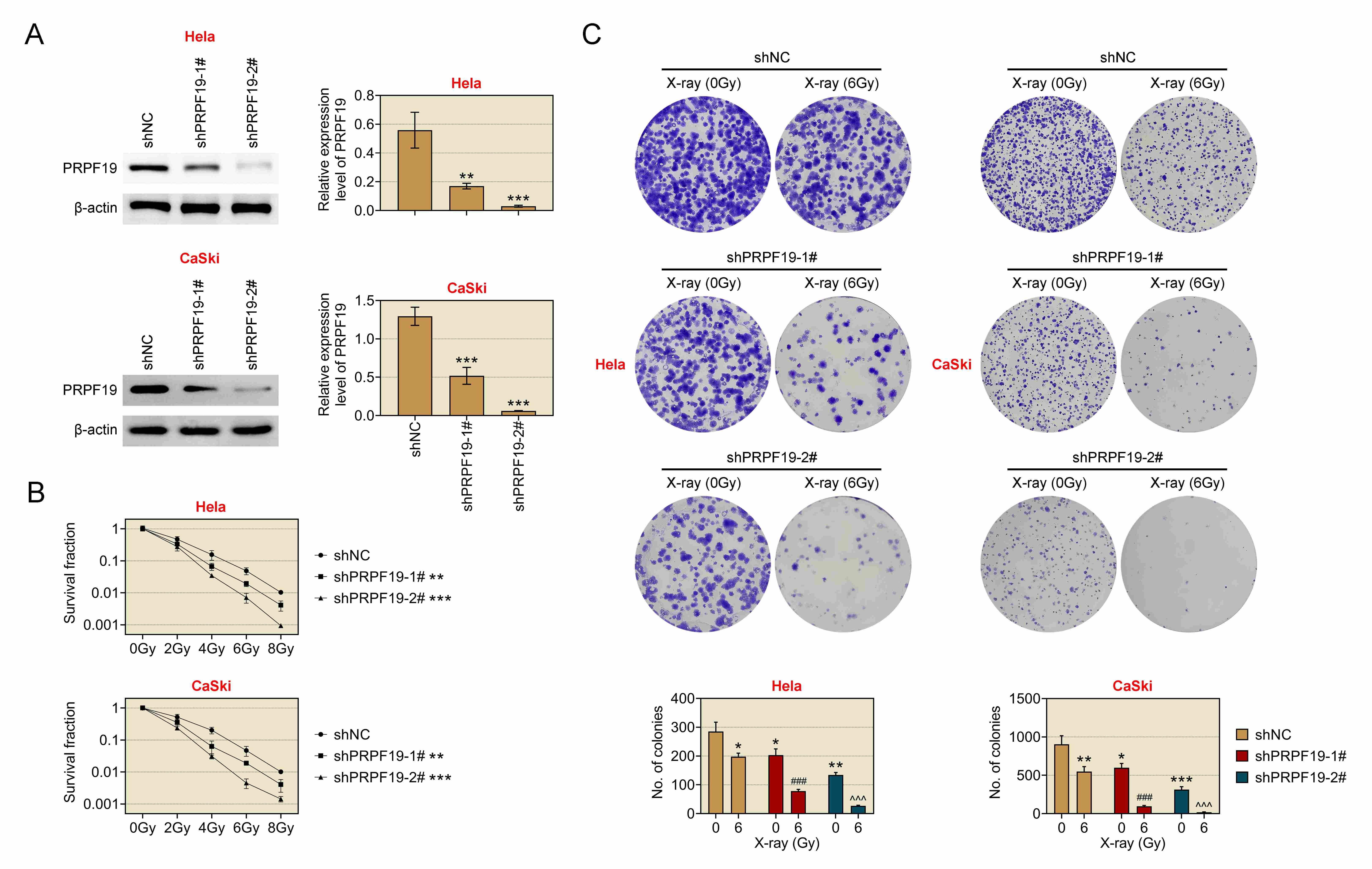 Inhibition of PRPF19 increases sensitivity to X-ray
treatment. (A) PRPF19 protein expression was measured in HeLa and CaSki cells
via western blot, which were categorized into the following groups: shNC,
shPRPF19-1# and shPRPF19-2#. **p < 0.01,
***p < 0.001. (B) Cell survival fractions were evaluated in
HeLa and CaSki cells using colony formation assay after exposure to 0, 2, 4, 6
and 8 Gy of X-ray irradiation. The groups included shNC, shPRPF19-1#, and
shPRPF19-2#. **p < 0.01, ***p < 0.001.
(C) Colony numbers were quantified in HeLa and CaSki cells after treatment with 0
or 6 Gy X-ray irradiation. The groups included shNC + X-ray (0 Gy), shNC + X-ray
(6 Gy), shPRPF19-1# + X-ray (0 Gy), shPRPF19-1# + X-ray (6 Gy), shPRPF19-2# +
X-ray (0 Gy), and shPRPF19-2# + X-ray (6 Gy). *p < 0.05,
**p < 0.01, ***p < 0.001, vs.
the shNC + X-ray (0 Gy) group; ###p < 0.001 vs. the
shPRPF19-1# + X-ray (0 Gy)
group; ^^^p < 0.001
vs. the shPRPF19-2# + X-ray (0 Gy)
group. PRPF19: Pre-mRNA-processing factor 19; shNC: Short hairpin negative
control.