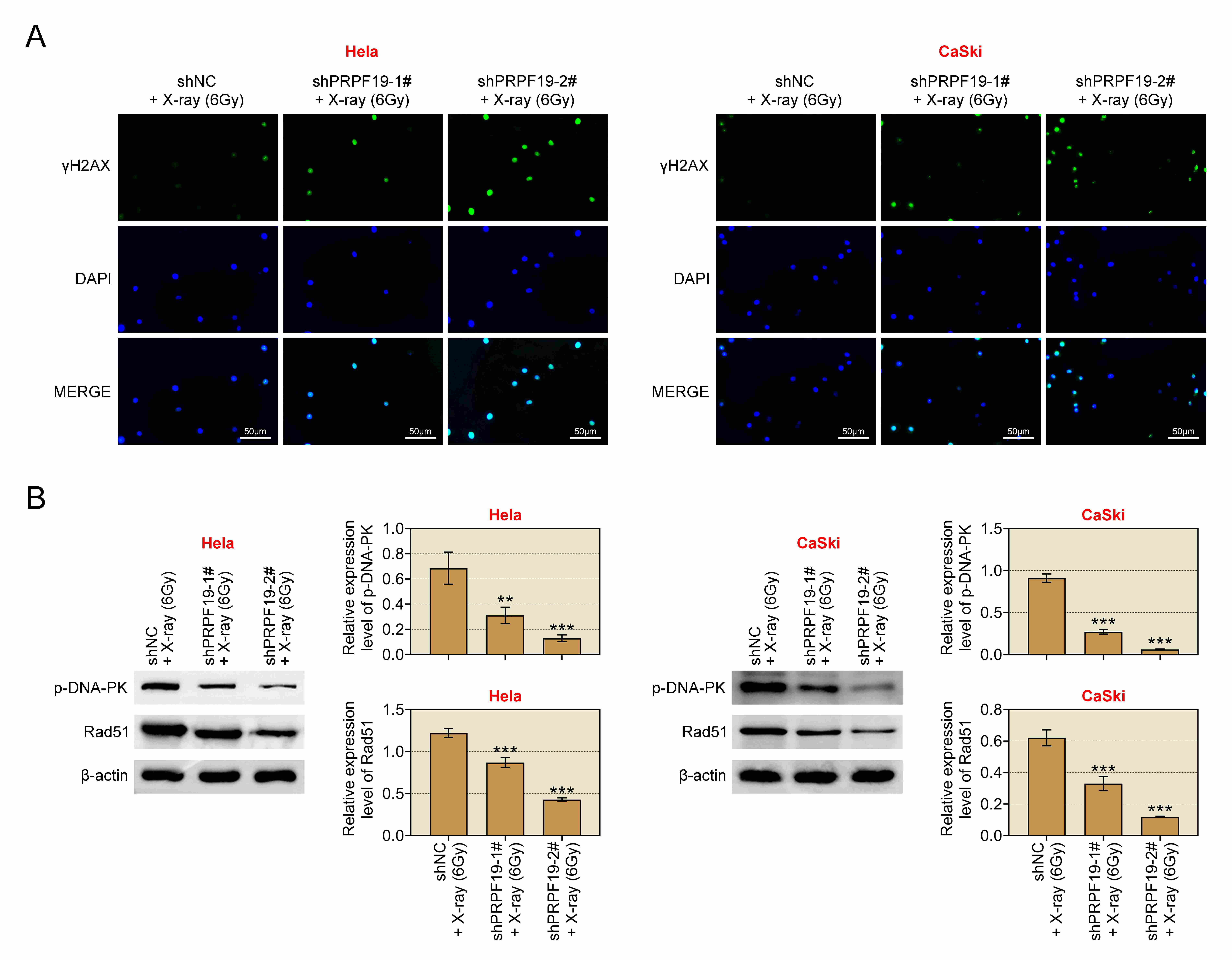 Knockdown of PRPF19 enhances DNA damage after X-ray
treatment. The groups assessed included shNC + X-ray (6 Gy), shPRPF19-1# +
X-ray (6 Gy), and shPRPF19-2# + X-ray (6 Gy). (A) γH2AX
fluorescence intensity was evaluated in HeLa
and CaSki cells using immunofluorescence assay. (B) The protein expression levels
of p-DNA-PK and Rad51 were measured in HeLa and CaSki cells via western blot.
**p < 0.01, ***p < 0.001.
PRPF19: Pre-mRNA-processing factor 19; shNC: Short hairpin negative
control; γH2AX: gamma-histone H2A family member X;
DAPI: 4′,6-diamidino-2-phenylindole; Rad51:
Rad51 recombinase; p-DNA-PK: p-DNA-protein kinase.