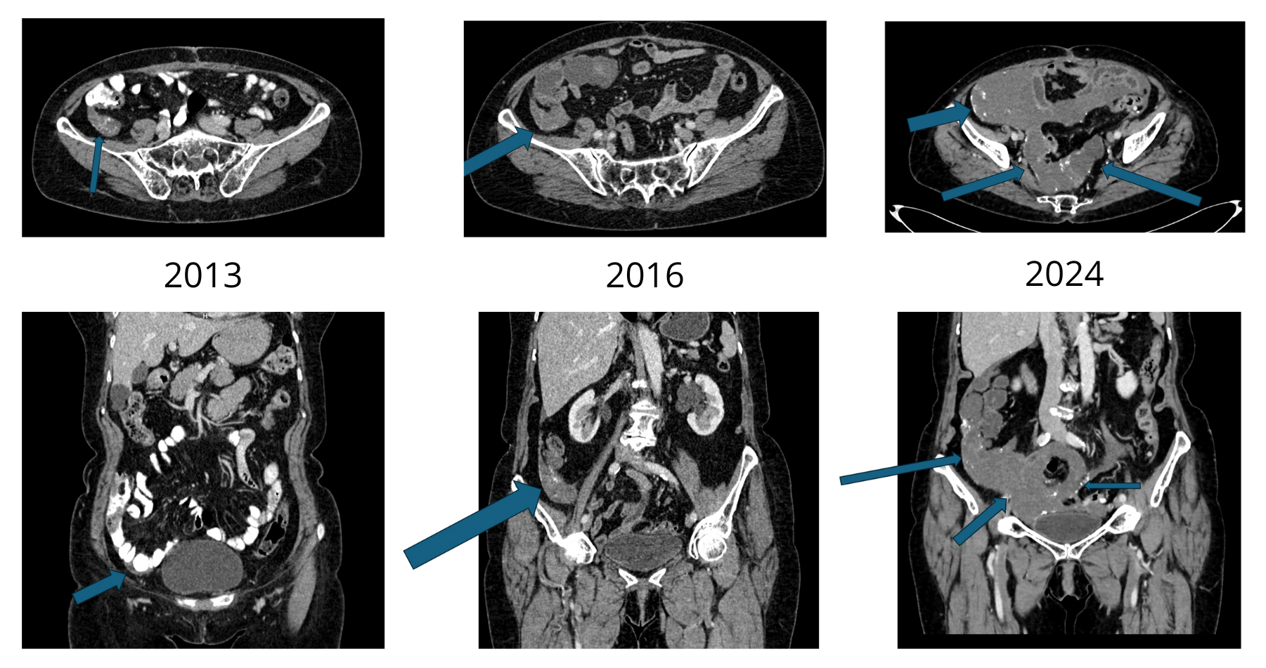 CT scans of patient’s ovarian lesions in years 2013, 2016 and
2024. Blue arrows pointing at tumor mass found on the CT scans.
