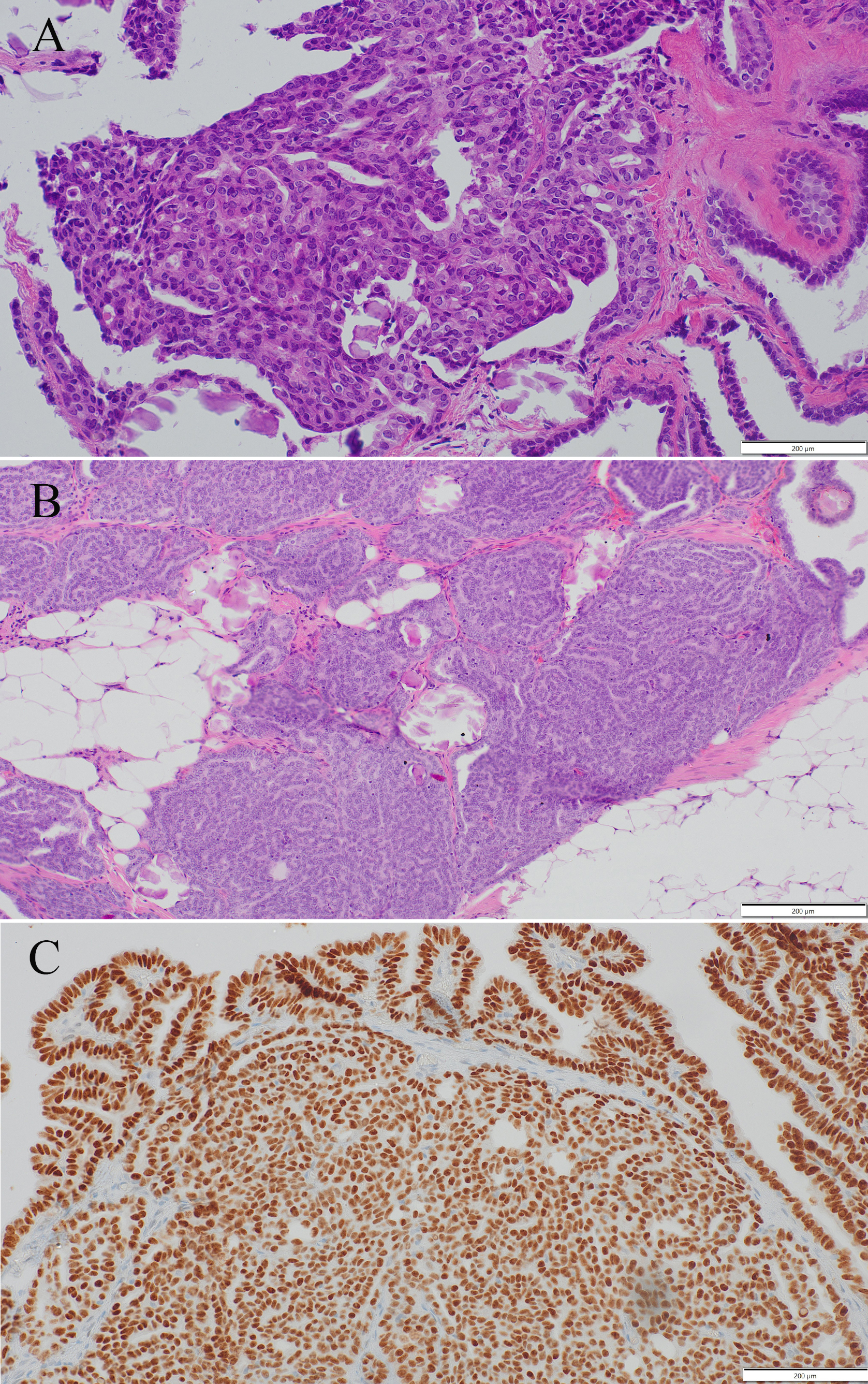 Histology Slides of ovarian tumor. (A) the year 2013, (B)
the year 2023, (C) PAX8 positive.