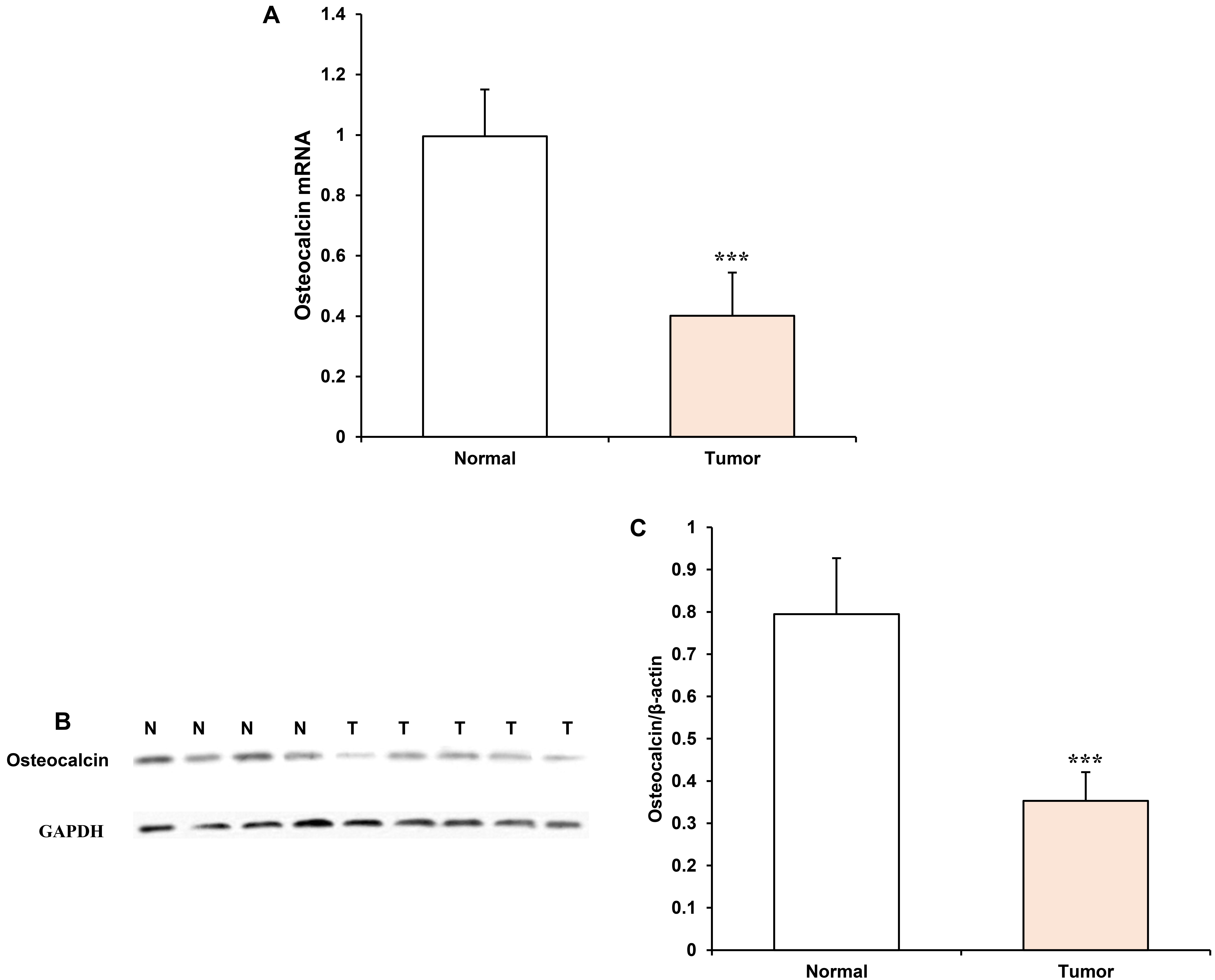 Expression of OCN in EC tissues. (A) mRNA expression of OCN in
normal endometrial tissues (n = 4) and EC tissues (n = 5). (B) Representative OCN
protein bands of Western blot in endometrial tissues (N) and EC tissues (T). (C)
Quantitative analysis shows that OCN protein level is lower in EC tissues as
compared to normal endometrial tissues. The data are presented as mean ±
SD. ***p < 0.001 vs. normal endometrial tissues. OCN,
osteocalcin; EC, endometrial cancer; GAPDH, glyceraldehyde 3-phosphate
dehydrogenase.