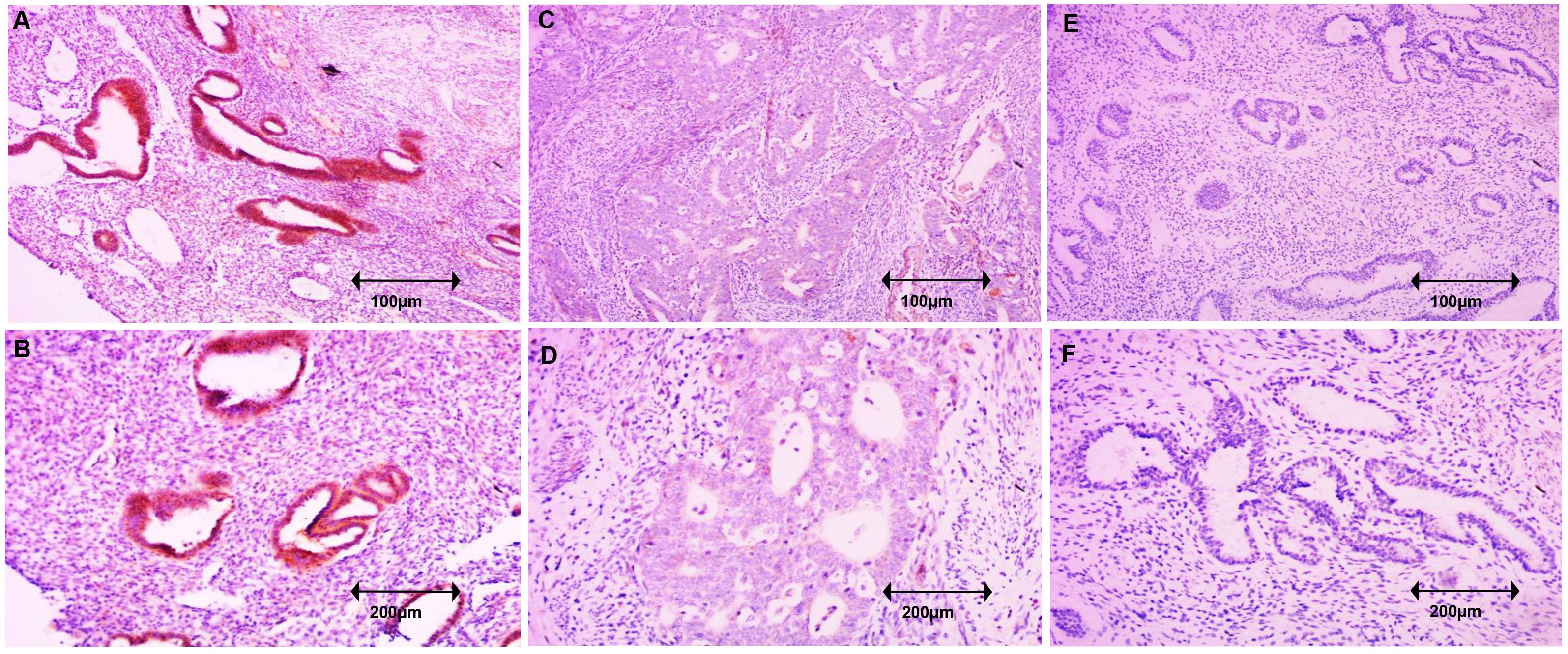 Immunohistochemical staining of OCN in EC tissues. (A,B) High
expression of OCN in normal endometrial tissues (×100; ×50).
(C,D) High/Weak expression of OCN in EC (×100; ×50). (E,F) Low
expression of OCN in EC (×100; ×50).