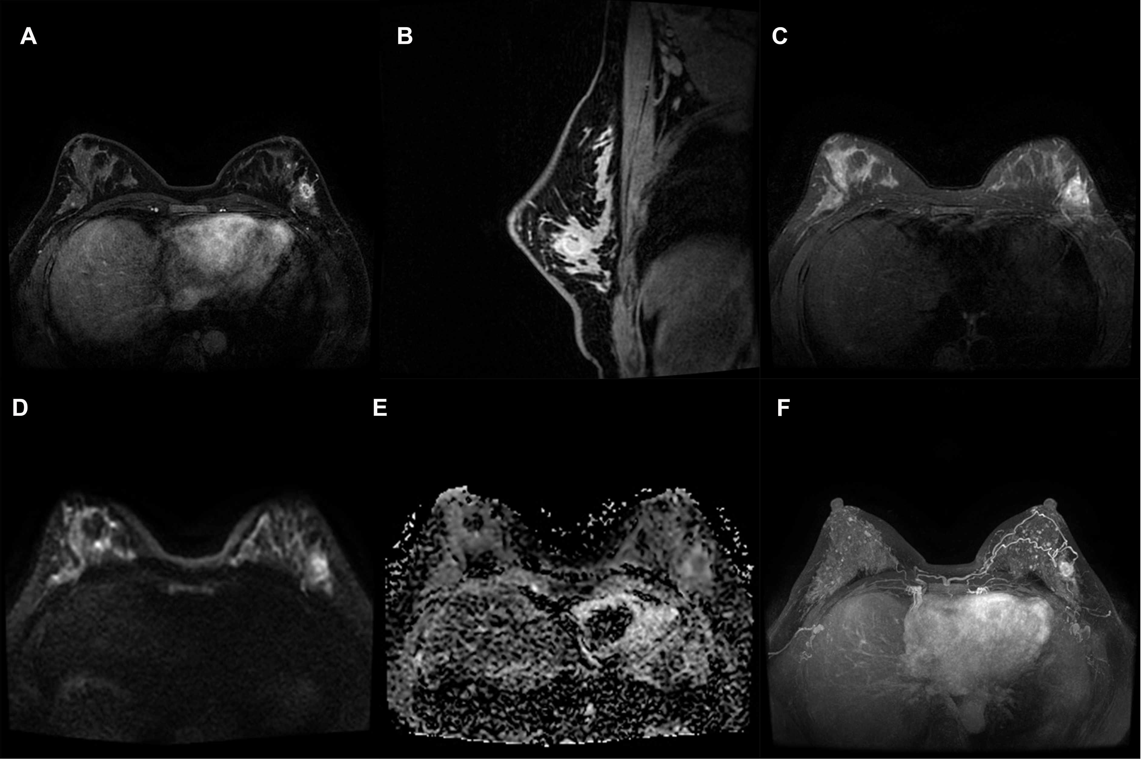 Representative images of invasive ductal carcinoma of the left
breast on dynamic contrast enhanced-magnetic resonance imageing. (A) T1WI + C
transverse position image. (B) T1WI + C sagittal position image. (C) T2WI image. (D)
Diffusion weighted imaging (DWI) with restricted diffusion. (E) ADC image. (F)
Three-dimensional maximal intensity projection of DCE-MRI breast image. WI: weighted imaging. DWI: diffusion-weighted imaging; ADC: apparent diffusion
coefficient.