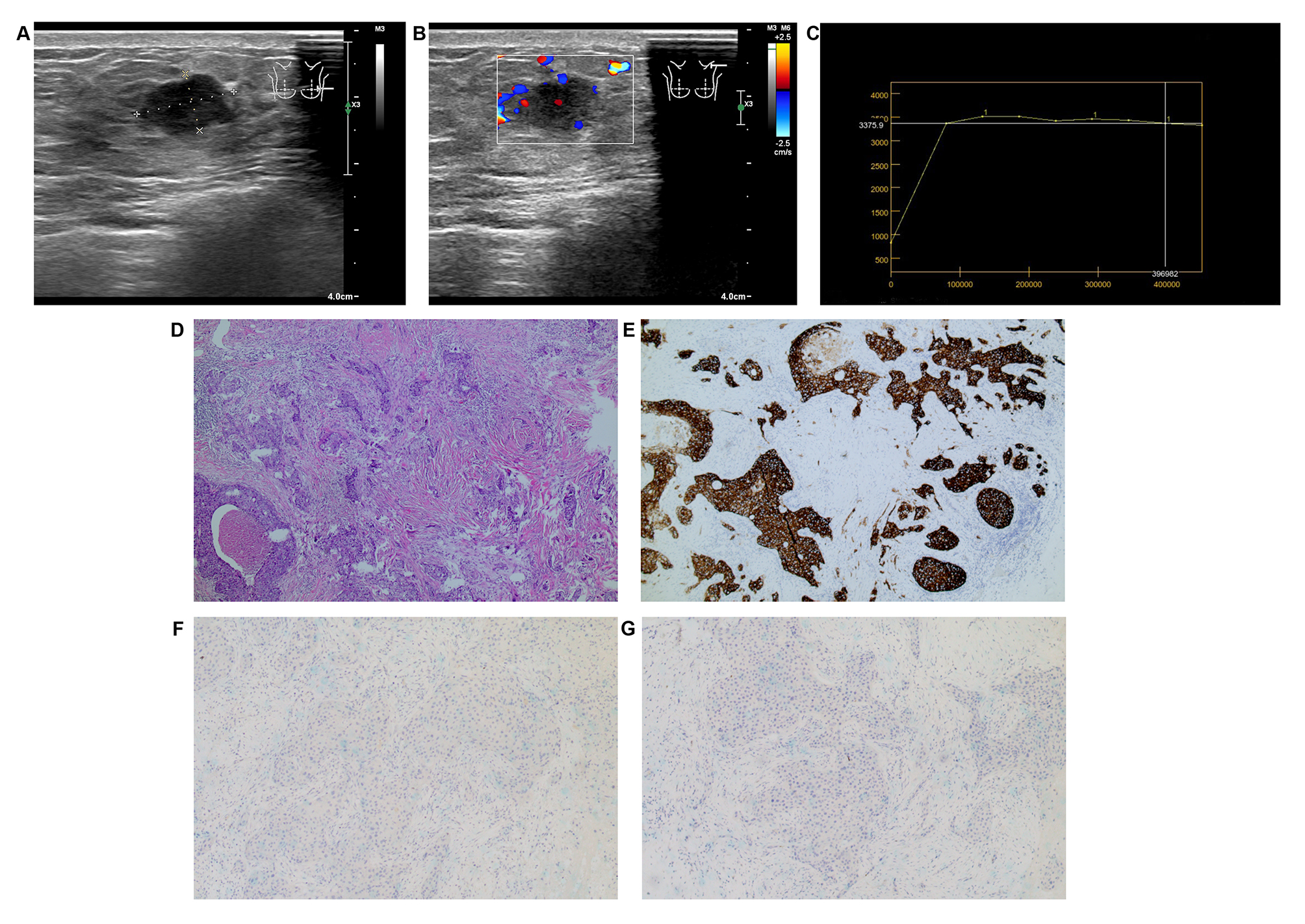Post-processing results of breast cancer patients. (A) The
tumor was irregular in shape with ill-defined margins and no significant
posterior echo attention. (B) Grade II-III blood flow signals. (C) TIC curve. (D)
HE stains (×100) showed invasive ductal carcinoma Grade III. (E)
Immunohistochemical (IHC) staining (×100) indicated HER2 was (+++). (F)
ER-negative (×100). (G) PR negative (×100).