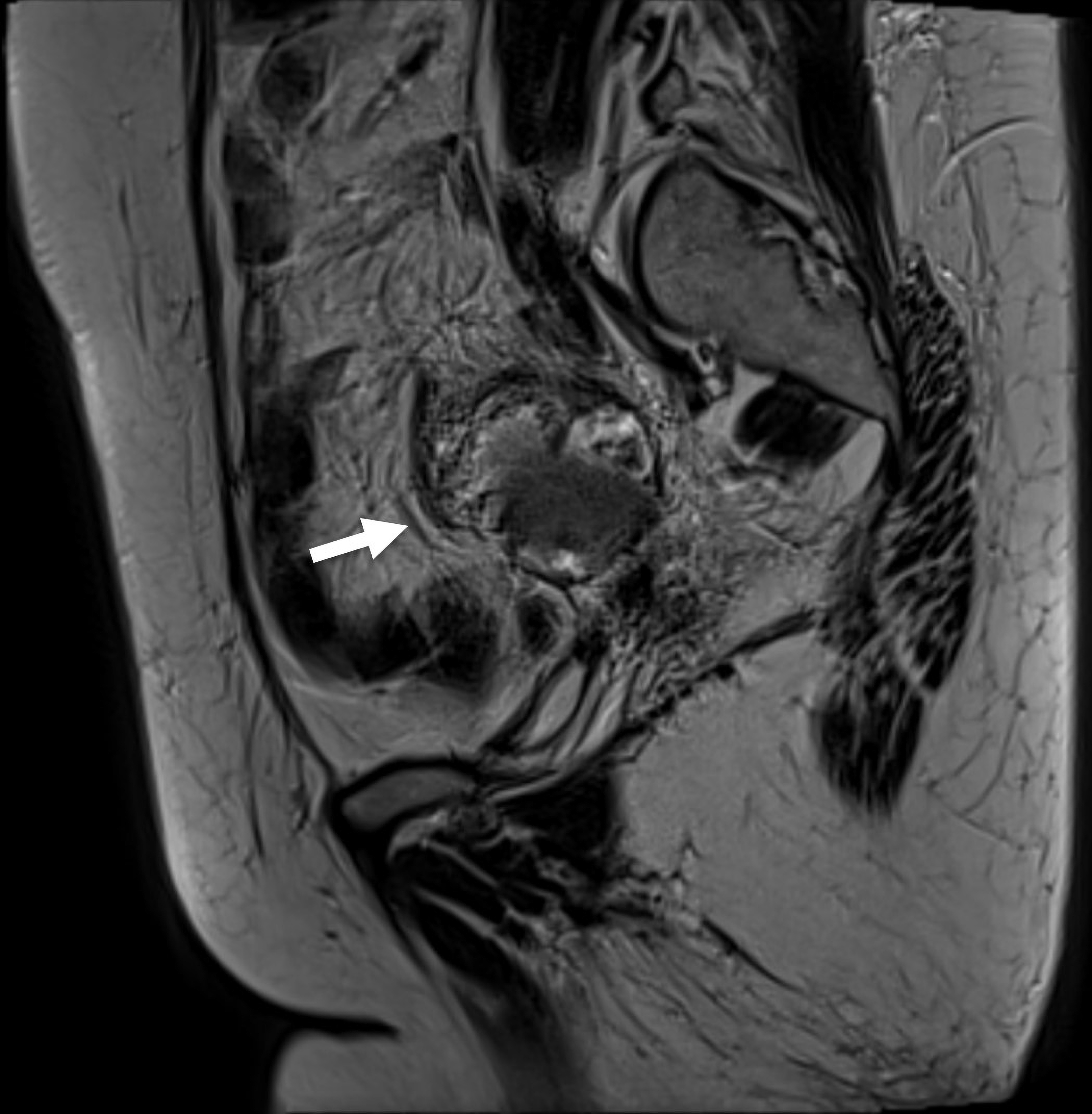 Magnetic resonance imaging of a recurrent lesion over the pelvic 
region. Increase enhanced soft tissue mass in the right pelvic region, suspect 
peritoneal tumor infiltration. Arrow indicated the location of the pelvic mass.