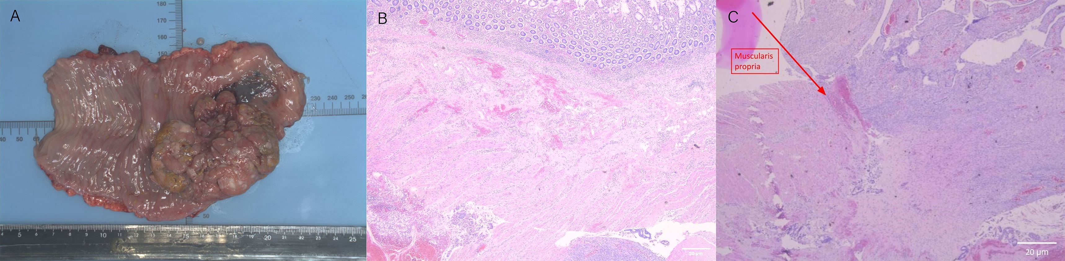 The pathology finding of small bowel resection. (A) Grossly, 
the tumor seemed to penetrate from ileum serosa into the submucosa. (B) 
Transaction of the tumor site revealed endometrioid carcinoma with mixed cystic, 
glandular, papillary and cribriform patterns infiltrating from the serosa into 
the muscularis and submucosa of the ileum. (C) Section shows endometrioid 
carcinoma with mixed cystic, glandular, papillary and cribriform patterns 
infiltrating from the serosa into muscularis and submucosa of ileum. The arrow 
points out the site of muscularis propria, which is invaded by malignancy as 
well.