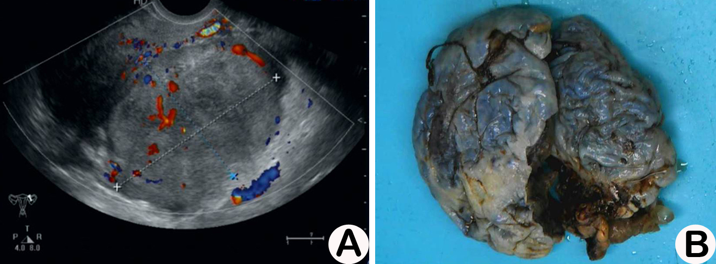 B-ultrasound
images and gross picture of tumour. (A) Colour ultrasound of case 2 suggested a
mass with slightly weak, uneven echo and a volume of approximately 8.0 cm
× 7.9 cm × 5.9 cm in the left posterior uterus. (B) Gross
examination showed a brown cystic-solid mass in the left ovary with a volume of
14 cm × 10 cm × 2.5 cm.