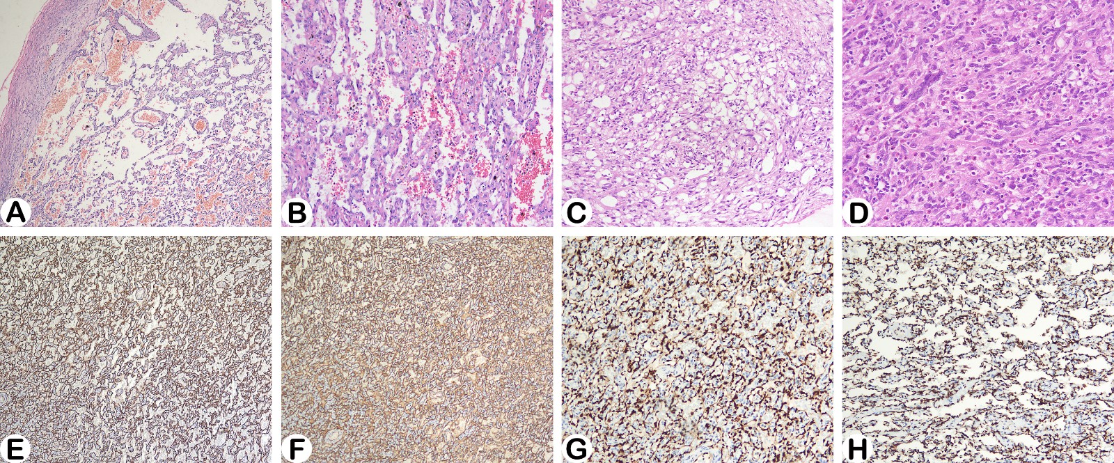 Histology and
immunohistochemical staining pictures of the tumour of case 1. (A) The
well-differentiated areas contained many vascular lumen structures of different
sizes (haematoxylin-eosin (HE) staining, 40×). (B) Some of these lumen
structures were dilated and filled with red blood cells. The lining of the cystic
wall contained mildly atypical tumour cells (HE staining, 100×). (C) A
few areas were composed of foam-like cells with vacuolated cytoplasm (HE
staining, 100×). (D) Some areas were poorly differentiated, with
scattered multinucleated giant tumour cells (HE staining, 200×). Tumour
cells was diffusely positive for CD31 (E), CD34 (F), ERG (G), FLI-1 (H) (IHC
staining, 100×).