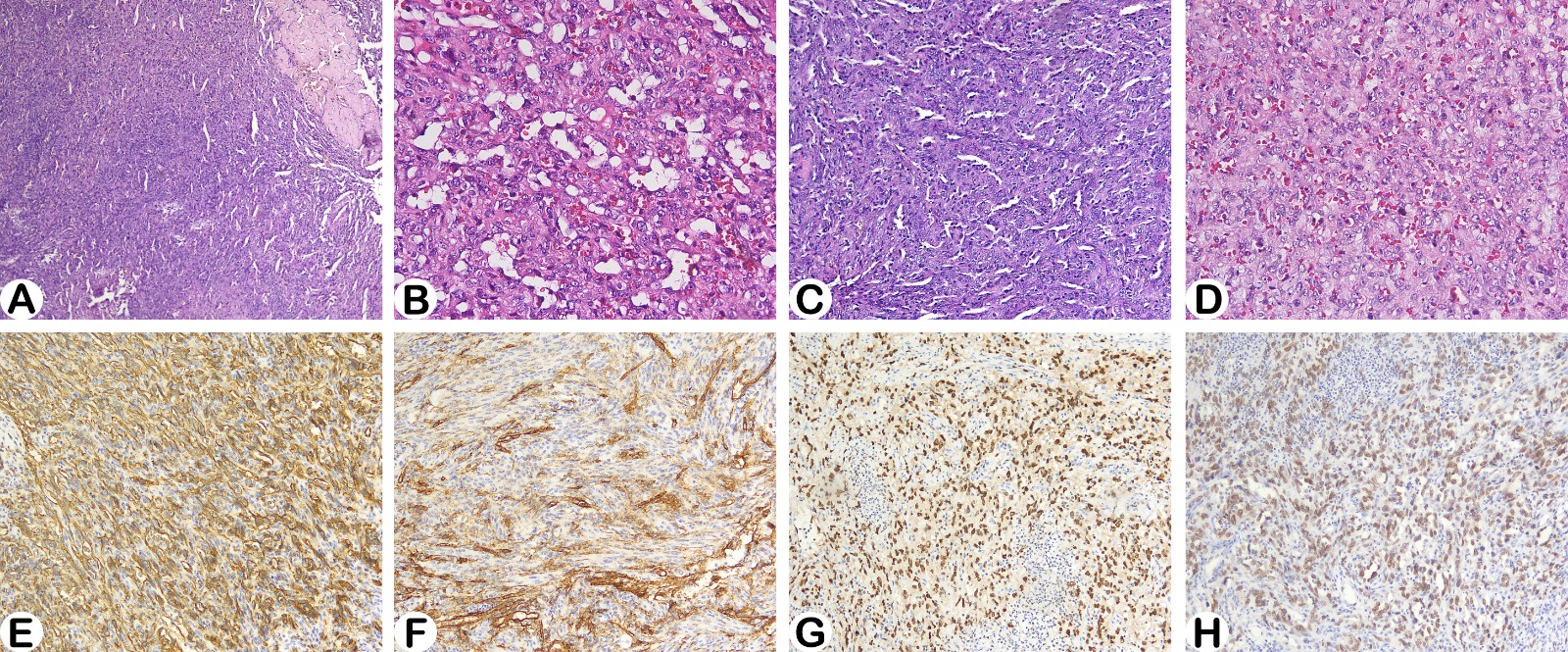 Histology and
immunohistochemical staining pictures of the tumour of case 2. (A) The
ovary was almost completely replaced by tumour tissues, and residual ovarian
leukosis was only observed in some local areas (haematoxylin-eosin (HE) staining,
40×). (B) In some regions the tumour showed clearly differentiated
vascular structures (HE staining, 100×). (C) Most regions consisted of
spindle shaped tumour cells which formed fissure-like structures (HE staining,
100×). (D) Round or polygonal cells with a patchy distribution were
observed in some local area side the tumours (HE staining, 200×). Tumour
cell showed diffusely positivity for CD31 (E), focal positivity for CD34 (F), ERG (G) and FLI-1 (H).