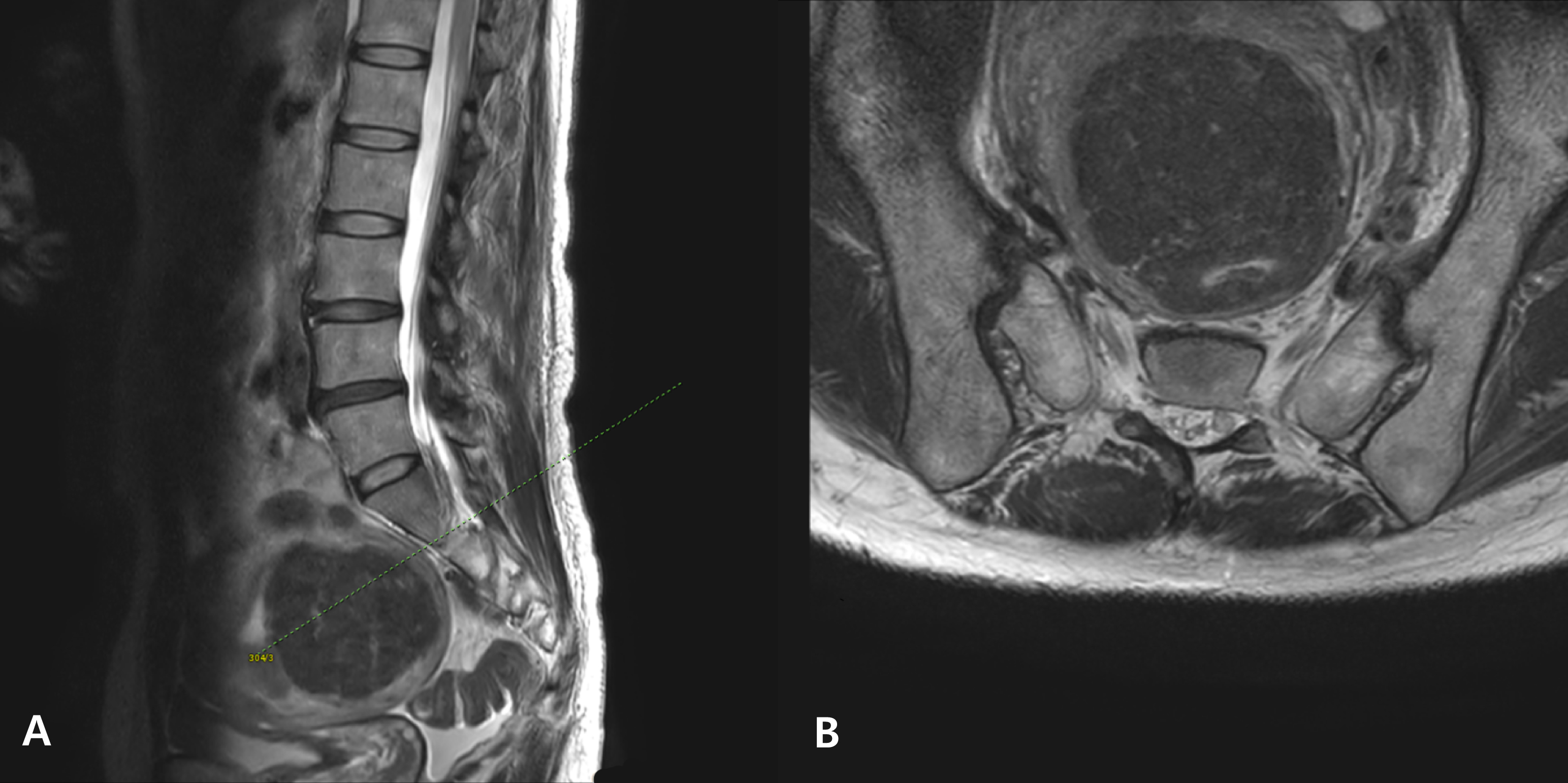 T2-weighted magnetic resonance images of the lumbosacral spine
and uterus. (A) Sagittal view and (B) axial view showing a uterine fibroid,
approximately 7.5 cm in size, located anterior to the sacrum and along the course
of the sacral or sciatic nerve. The line in (A) indicates the position of the
axial plane.