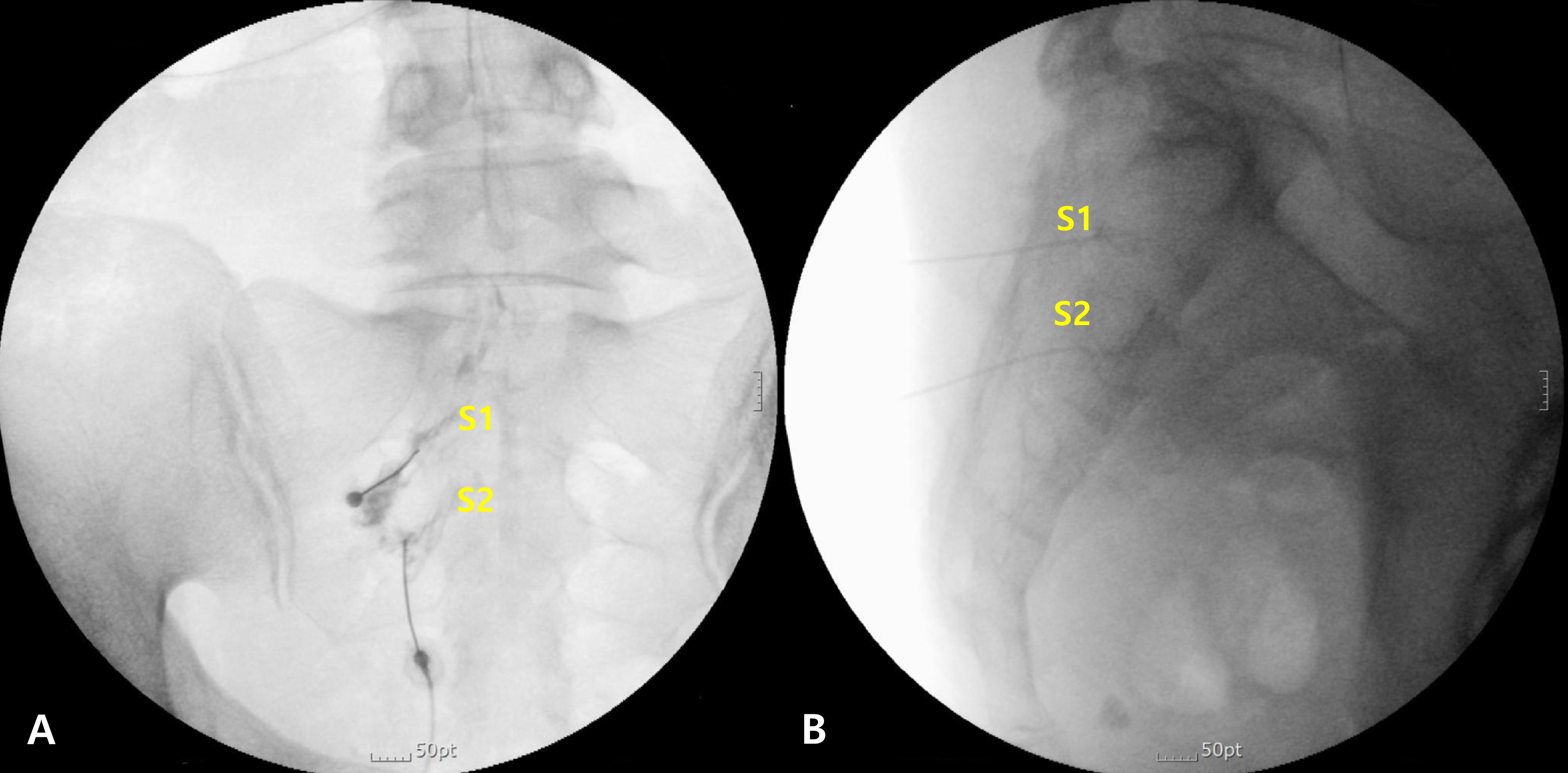 Fluoroscopic images of nerve root pulsed radiofrequency
treatment with contrast medium injection. (A) Anteroposterior and (B) lateral
images showing the needle placed at the left sacral 1 (S1) and sacral 2 (S2)
nerve roots. The contrast agent is well distributed along the nerve pathways.
After confirming that the radiofrequency nerve stimulation is concordant with the
patient’s symptoms, pulsed radiofrequency treatment was performed.