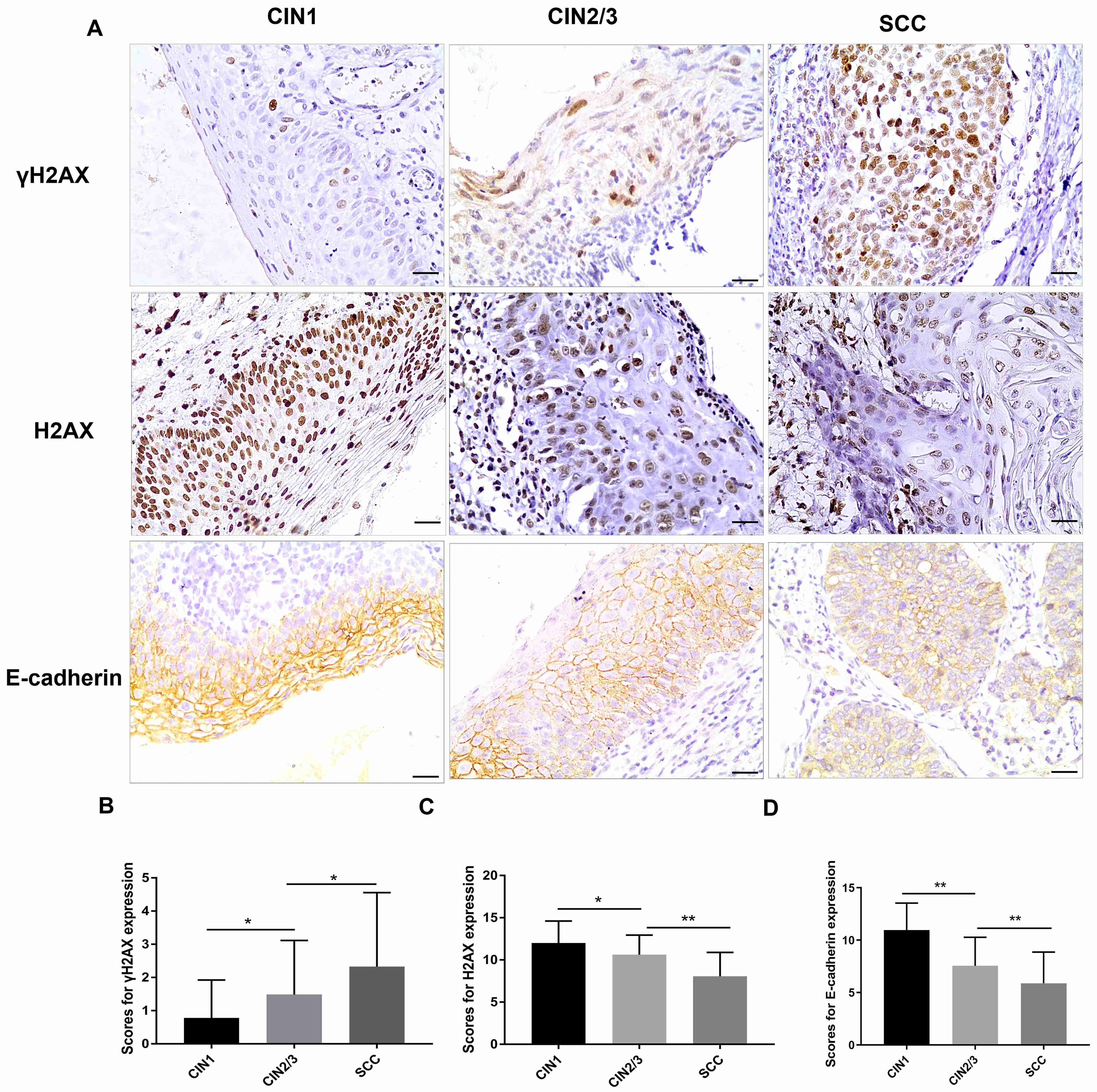 Immunohistochemical staining of γH2AX and H2AX
in cervical intraepithelial neoplasia specimens. Representative stained images
of γH2AX, H2AX and E-cadherin in CIN 1, CIN 2/3 and squamous cell
carcinoma (SCC) specimens (A). Comparison between the expression of
γH2AX (B), H2AX (C) and E-cadherin (D) in CIN 1, CIN 2/3, and SCC cases
(N = 32, N = 34 and N = 87, respectively). Scale bar = 300 μm. *,
p < 0.05; **, p < 0.01. CIN: cervical intraepithelial
neoplasia.