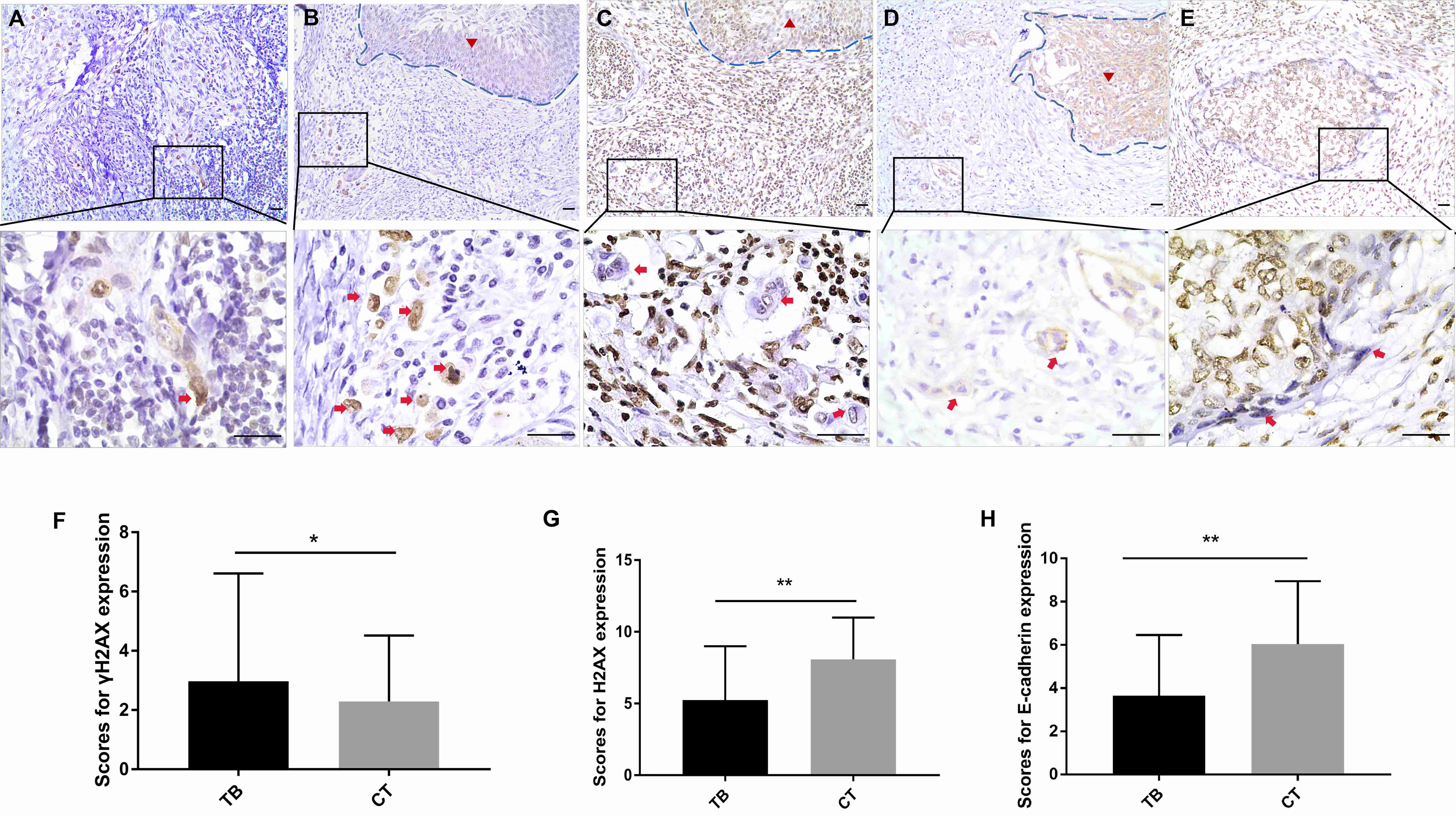 Immunohistochemical staining of γH2AX and H2AX
in central tumors and tumor budding. Representative stained images of
γH2AX at the front of deeply invading nests (the area indicated by the
red arrow) (A). Representative stained images of γH2AX (B), H2AX(C) and
E-cadherin (D) in central tumors (the area indicated by the red triangle inside
the region enclosed by the blue-dotted-line) and tumor budding (the cells
indicated by red arrows). Representative images of morphology and H2AX expression
in cancer cells at the margins of cancer nests (the cells indicated by red
arrows) (E). A comparison between the expression of γH2AX (F), H2AX (G),
and E-cadherin (H) in central tumors and tumor budding in the same patients (N =
78). Scale bar = 300 μm. CT: central tumors; TB: tumor budding. *,
p < 0.05; **, p < 0.01.