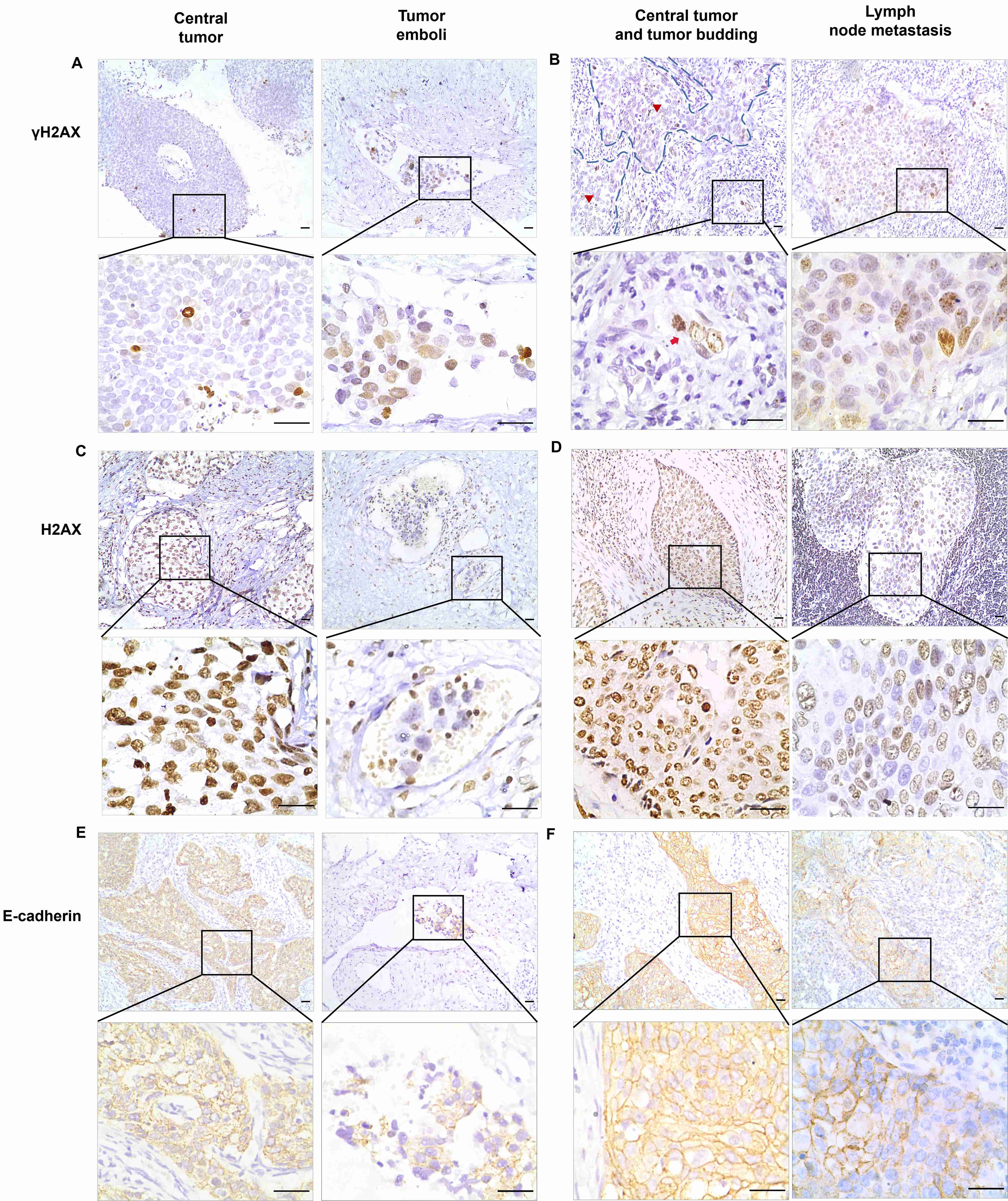 Immunohistochemical staining of γH2AX, H2AX and
E-cadherin in central tumors, tumor budding, tumor emboli and metastatic lymph
nodes. Representative stained images of γH2AX (A), H2AX (C) and
E-cadherin (E) in central tumors and tumor emboli in the same patient.
Representative stained images of γH2AX in central tumors (the area
indicated by the red triangle inside the region enclosed by the
blue-dotted-line), tumor budding (the cells indicated by red arrows), and
metastatic lymph nodes in the same patient (B). Representative stained images of
H2AX (D) and E-cadherin (F) in central tumors and metastatic lymph nodes in the
same patient. Scale bar = 300 μm.
