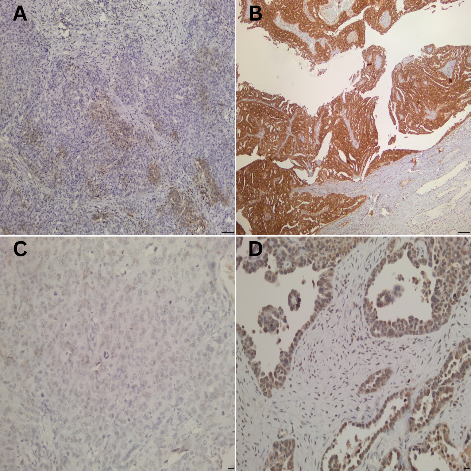 Immunohistochemical staining of FOXO1 and PAX3 in HGSOC samples (scale bar: 100 μm). (A) FOXO1 <10% positively stained
cells and weak staining intensity (negative). (B) FOXO1 >10% positively
stained cells and strong staining intensity (positive). (C) PAX3 <10%
positively stained cells and weak staining intensity (negative). PAX3 >10%
positively stained cells and moderate staining intensity (positive).