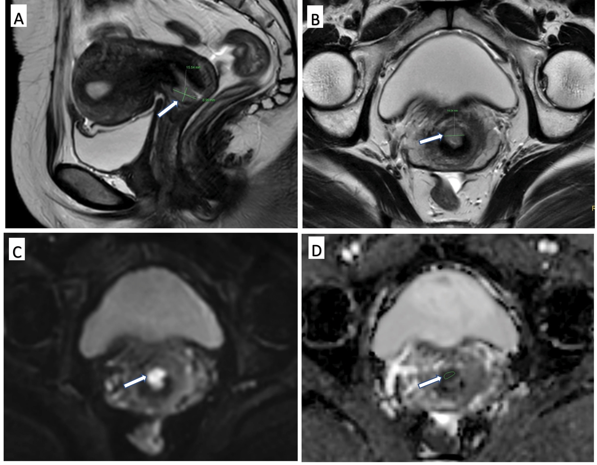 Delineation of ROIs and 
measurement of the greatest dimension. MRI scans of a 58-year-old woman showing 
moderately differentiated squamous cell carcinoma negative for PMI. The tumor 
(white arrow) showed a slightly hyperintense signal on sagittal T2WI (A) and 
axial T2WI (B), and the corresponding axial DWI (C) and ADC maps (D) showed 
high- and low-intensity signals, respectively. The green lines indicate the tumor 
diameters in different planes, and the largest value in each plane was recorded 
as the greatest dimension. ROIs were drawn with reference to DWI and other 
sequences and on ADC maps (D) (ROI: region of interest).