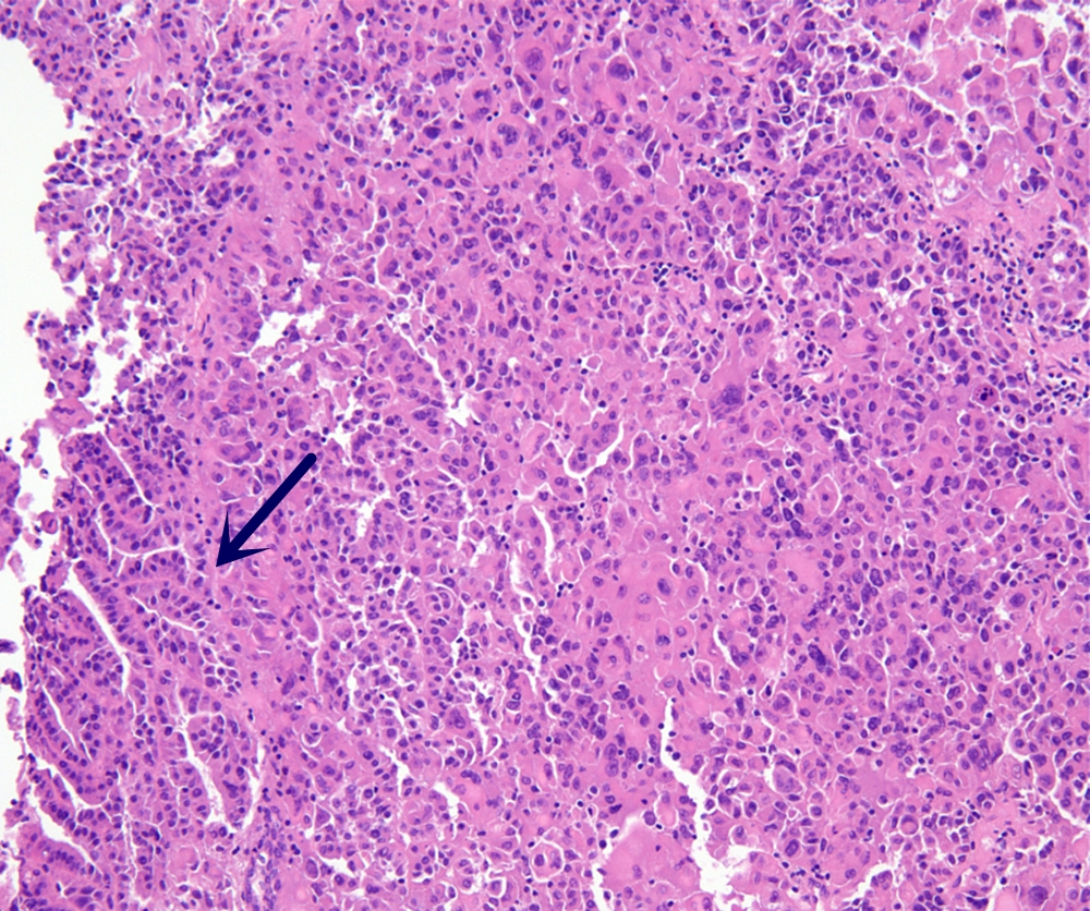 Tumor histopathology. The endometrial tumor was remarkably 
composed of a large number of giant cells in sheet-like growth pattern, a small 
portion was found to consist conventional EC components (black arrow).
