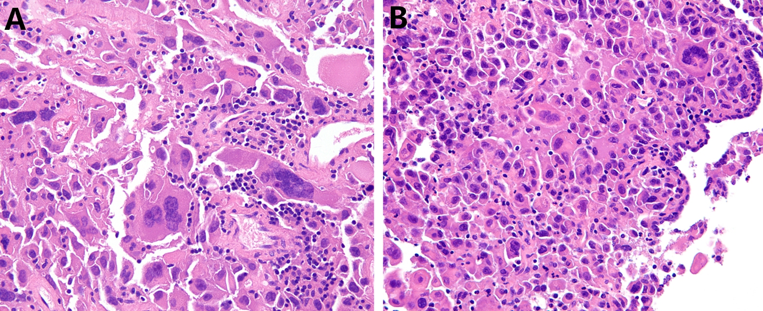 Tumor histopathology. The giant tumor cells contained abundant 
eosinophilic cytoplasm and vesicular nuclei with prominent nucleoli, which 
presented as multinucleated giant cells (A) and mononucleated giant cells (B).