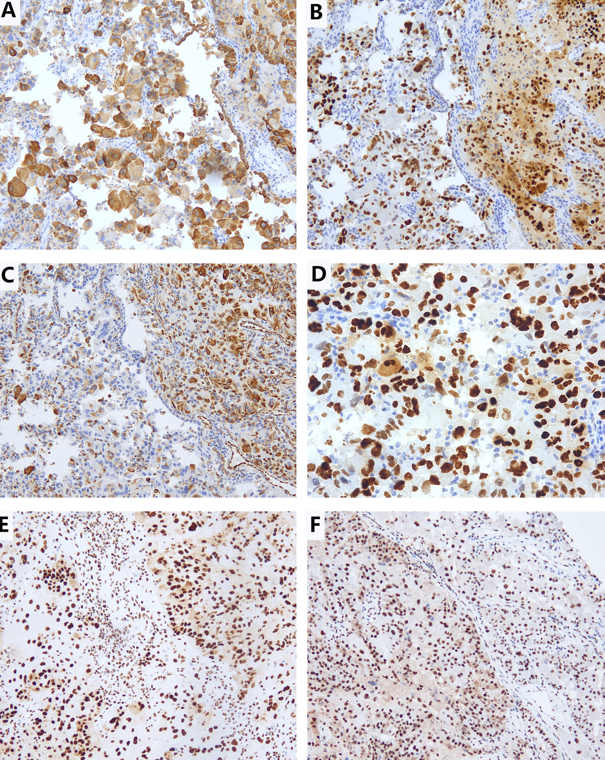Tumor immunophenotype. Immunohistochemistry demonstrated 
positive staining for EMA (A), p53 (B) and Vimentin (C) in all tumor cells, 
mismatch repair proteins (the marker shown in D was MSH6), SMARCA4 (E) and 
SMARCB1 (F) were retained.