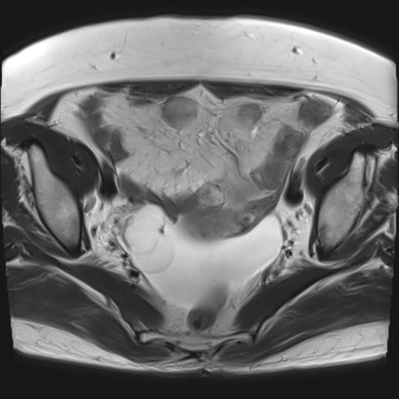Magnetic resonance imaging (MRI) of a 4.2 × 3.1 
× 3.1 cm septated cystic mass in the right ovary with no inner diffusion 
restriction or enhancement and the presence of ascites.