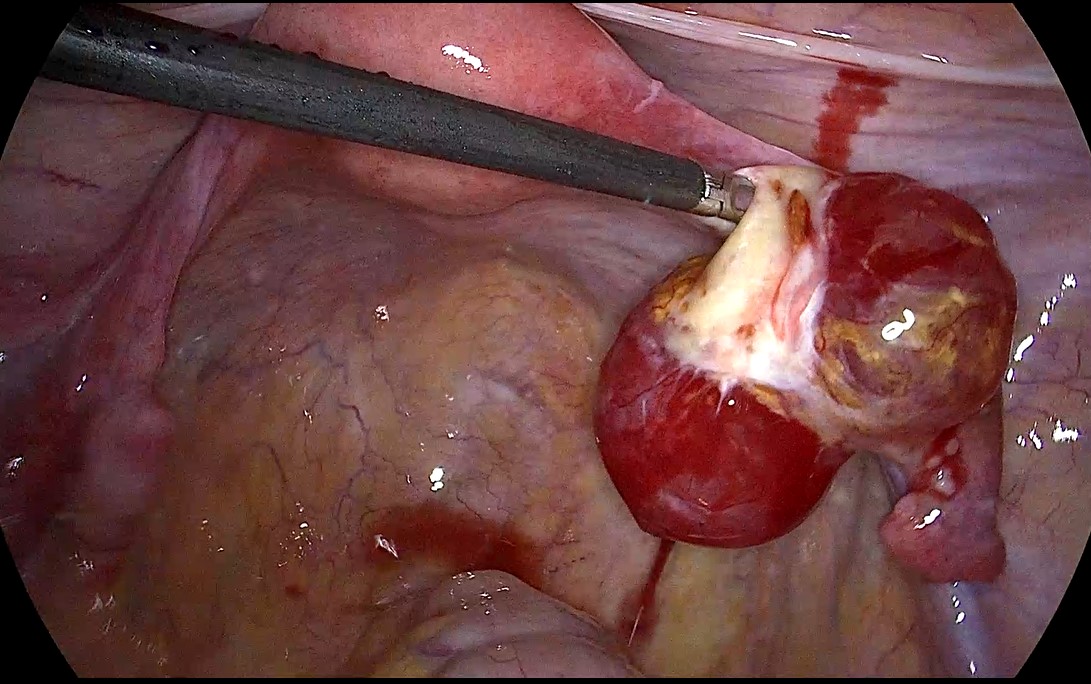 Laparoscopic view of a cystic tumor with a thin wall and 
hemoserous fluid in the right ovary.