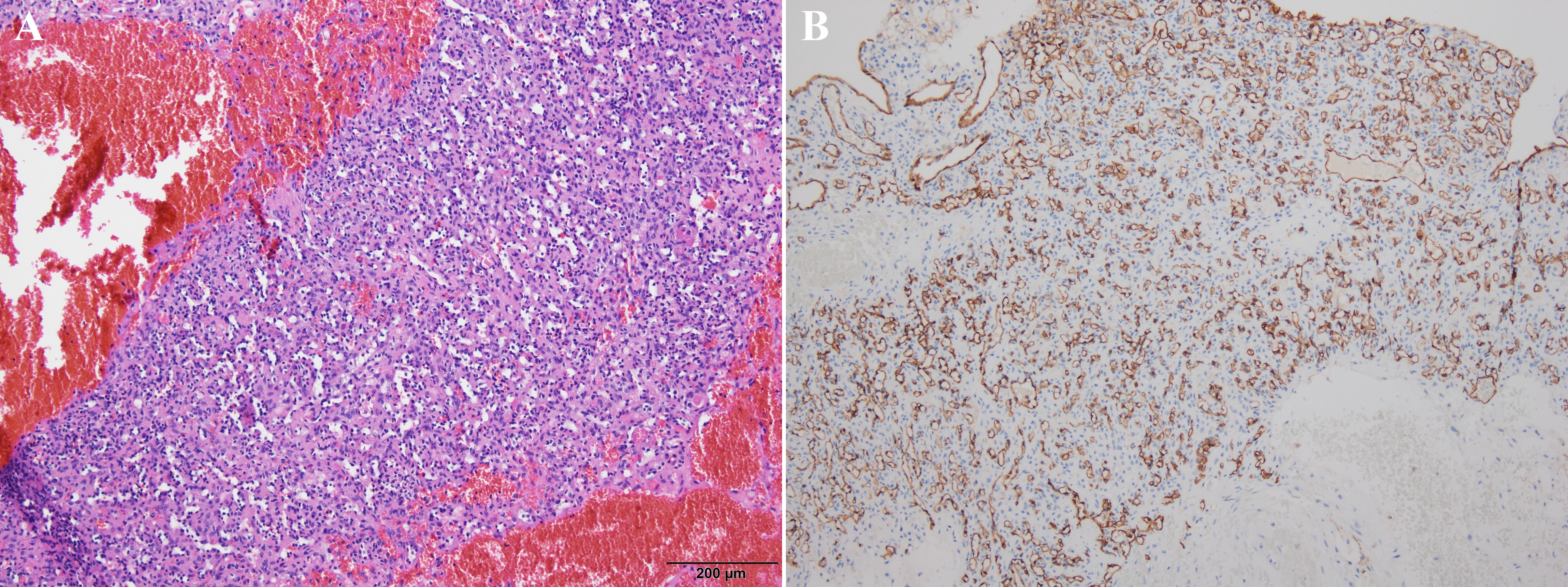 Microscopic findings. (A) Hematoxylin and eosin stain revealing 
proliferation of capillary-sized vascular spaces (H&amp;E stain, 
100×). (B) Immunohistochemical staining of CD34 highlighting 
endothelial cells lining the vascular spaces (CD34 stain, 
100×).