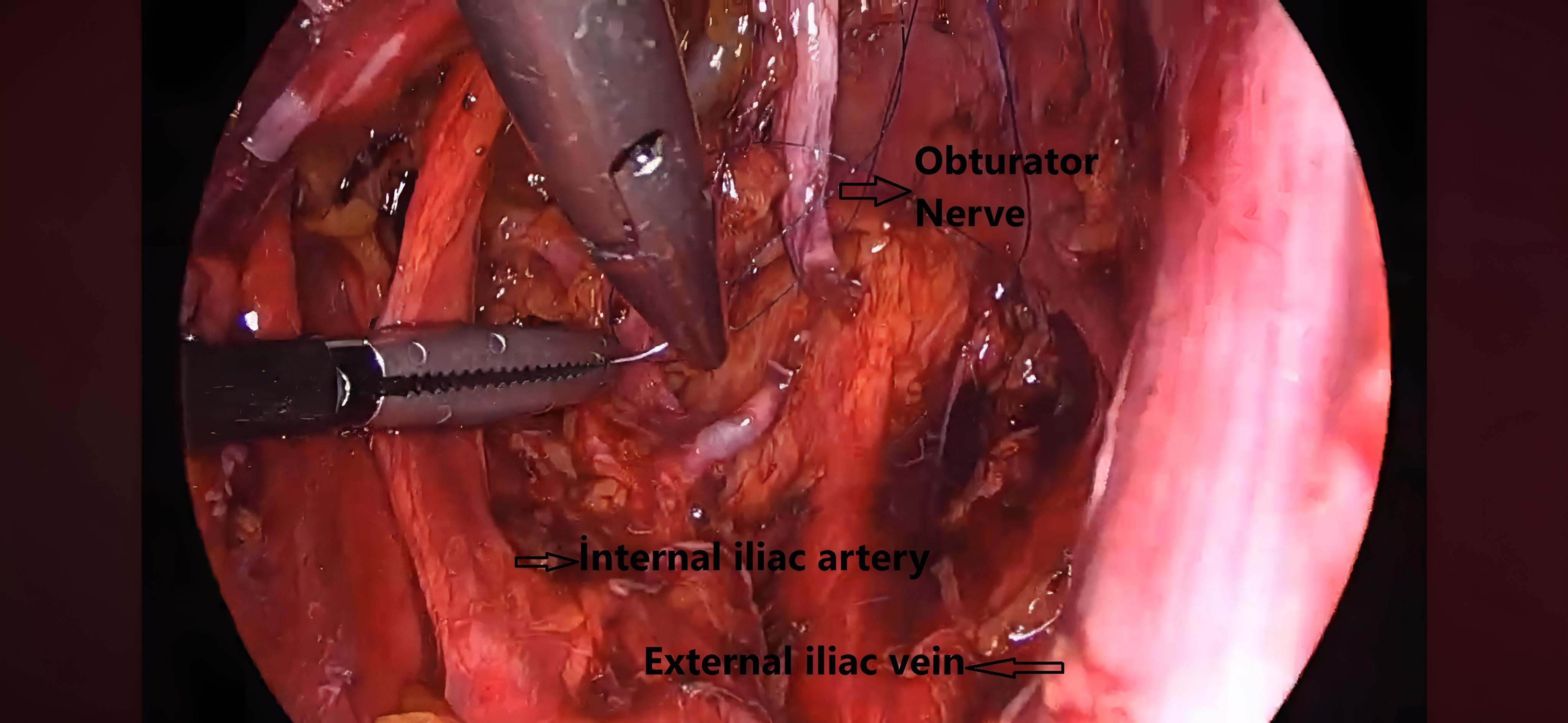 Obturator nerve cut image.