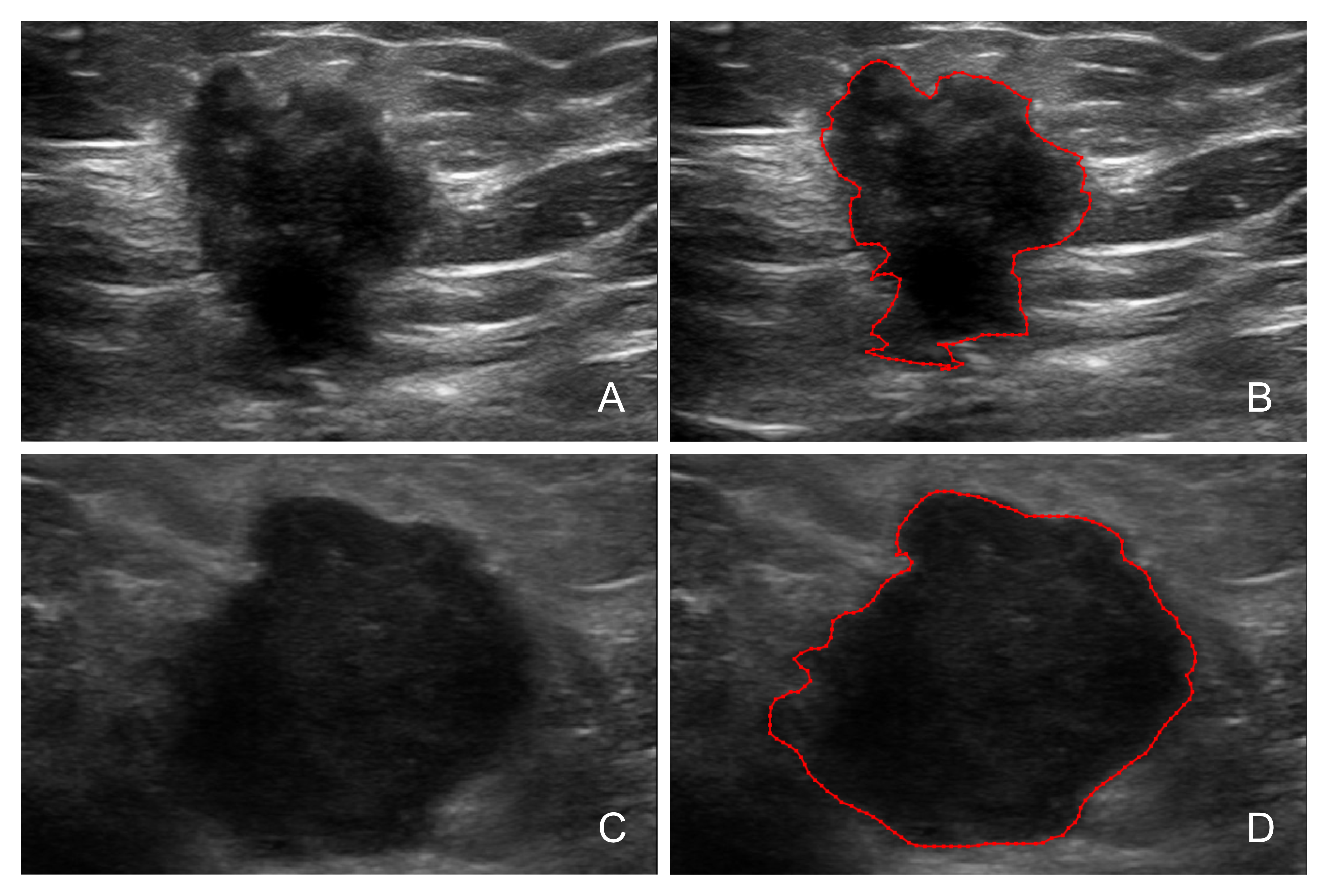 Delineation of the region of interest on breast cancer 
ultrasound images. (A,B) The image of a 45 year old female with 
non-triple-negative breast cancer; (C,D) The images of a 58 year old female with 
triple negative breast cancer. (A) and (C) show the original images, and (B) and 
(D) show the segmented images.