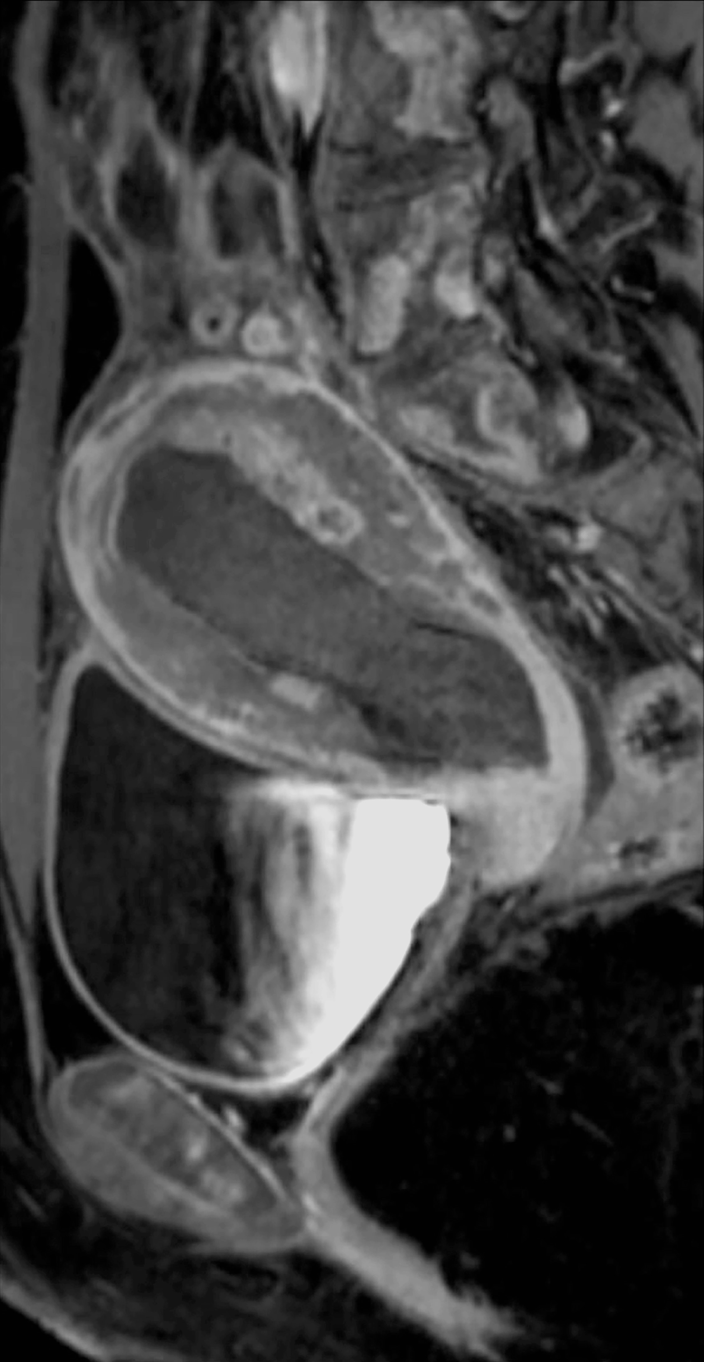 Abdomino-pelvic MRI. Sagittal T1 contrast-enhanced section which 
showed heterogeneous thickening of the entire uterine wall, identifying a widened 
myometrium occupied by a hypointense infiltrative lesion suggestive of leukaemic 
infiltration.