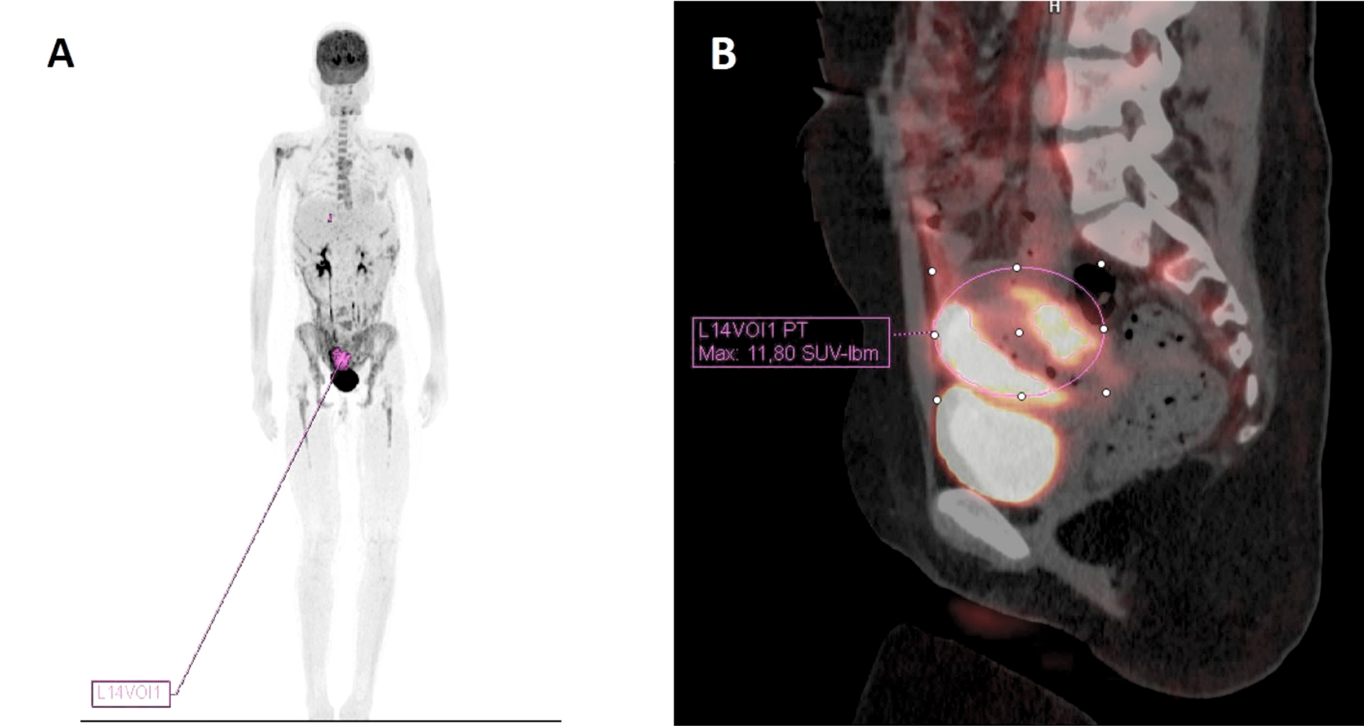 18-Fluorodeoxyglucose positron emission tomography-computed 
tomography (18F-FDG-PET/CT). (A) Coronal section showing increased metabolism in 
uterus, moderate/intense diffuse increase in osteomedullary glycaemic metabolism 
suggestive of infiltration and signs of peritoneal/mesenteric infiltration 
predominantly in the perihepatic and perihepatic region. (B) Sagittal section 
showing an enlarged uterus with heterogeneous thickening of the entire wall and 
associated intense glycaemic hypermetabolism, predominantly inferior with 
Standardized Uptake Value (SUV) max 11.8. SUV: Standardized Uptake Value.