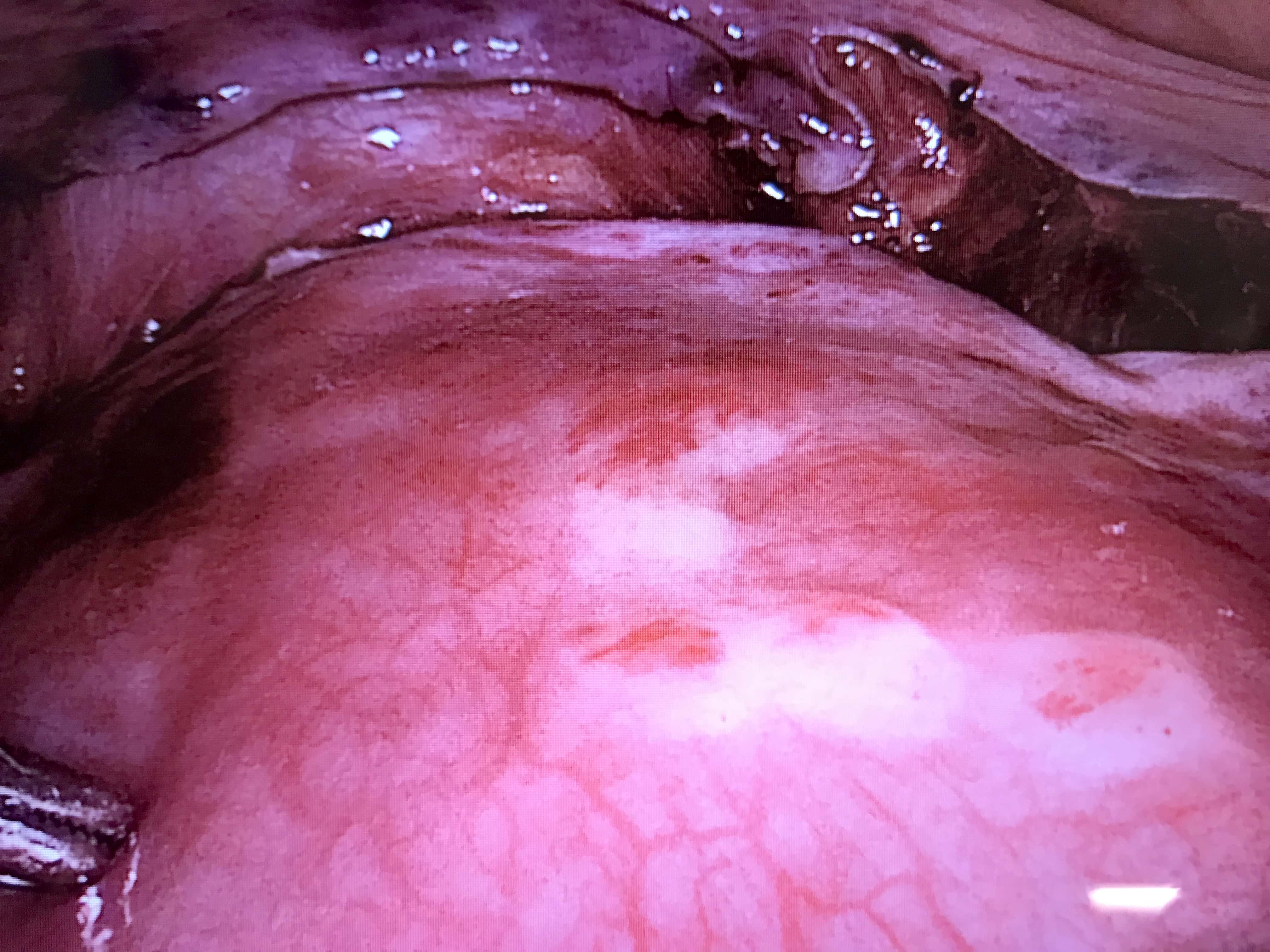 Laparoscopic vision of the uterus and bladder peritoneum with 
clear signs of leukemic infiltration.