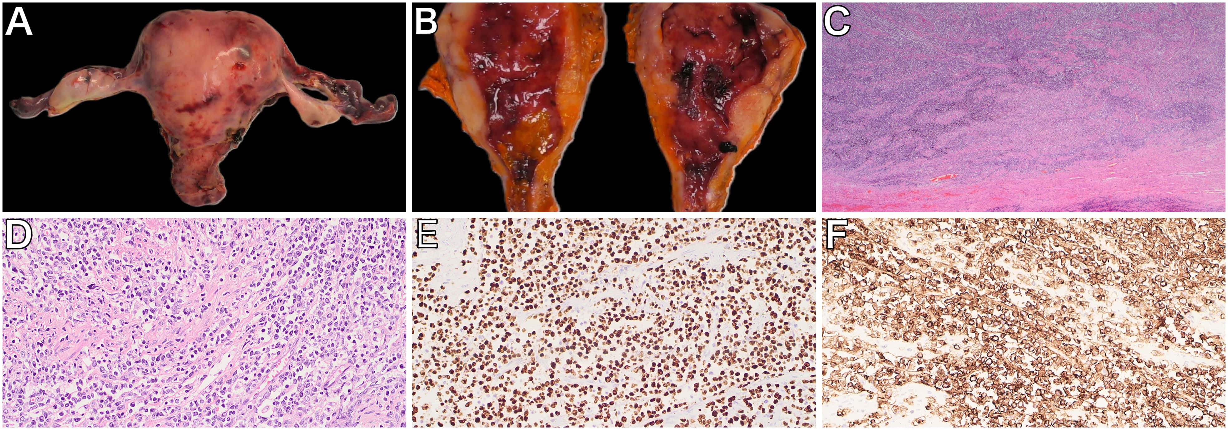 Pathology results. (A) Hysterectomy and bilateral 
salpingo-oophorectomy. (B) Open uterus after removing intraluminal blood, showing 
thickened myometrium with white ill-circumscribed lesions. Microscopic 
photographs showing diffuse blastic infiltration of the myometrium (HE 
×4 (C), HE ×40 (D)) with immunoexpression of PAX5 
(×40) (E) and CD10 (×40) (F).