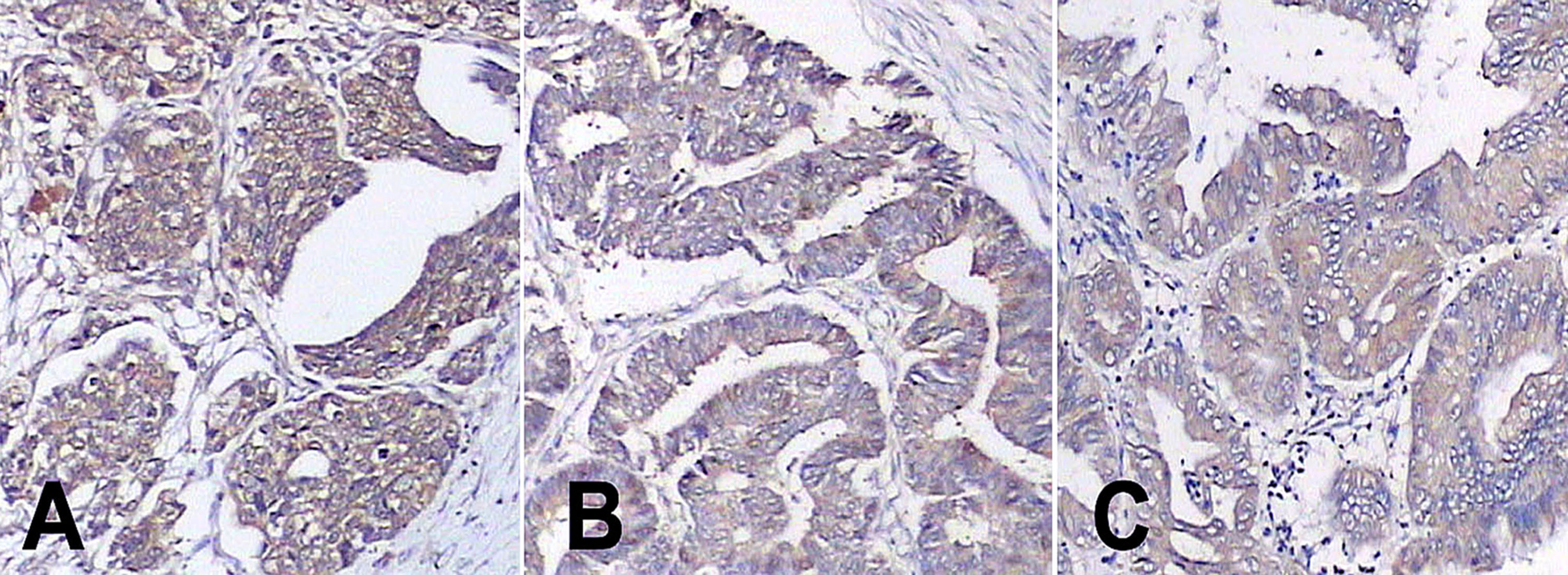 Strong cytoplasmic 
expression of KIM-1 in tumor cells. (A) Serous Carcinoma (B) Endometrioid 
Carcinoma (C) Mucinous Carcinoma (DAB ×200). DAB: 
Diaminobenzidine.