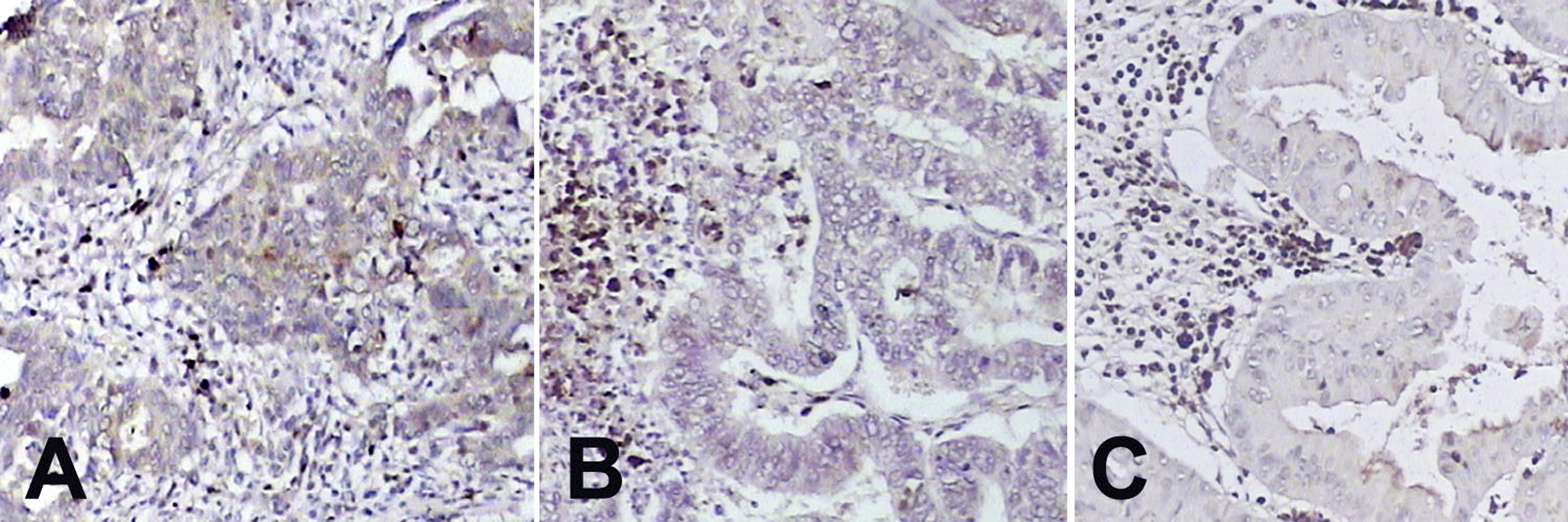 Note the weak cytoplasmic 
NGAL-expressions in the tumor cells relative to the inflammatory cells. (A) 
Serous Carcinoma (B) Endometrioid Carcinoma and (C) Mucinous Carcinoma (DAB 
×200). DAB: Diaminobenzidine.