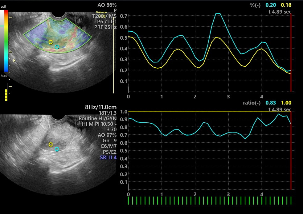 Transvaginal strain sonoelastography image of a 58-year-old
woman with endometrial carcinoma. The right side shows the two images obtained
by transvaginal sonographic transducer. The upper shows the elastography mode
while the lower shows the routine B-mode sonography. The two circles represent
the target lesion and the reference Region of Interest (ROI) which were used for
the calculation of Strain Ratio (SR). Green circle (reference Region of Interest)
is placed on the endometrium and the yellow circle on the intact myometrium. The
right lower side shows the lines obtained from the Region of Interests (ROIs) and
indicates the Strain Ratio (SR) of endometrial lesion versus intact myometrium.