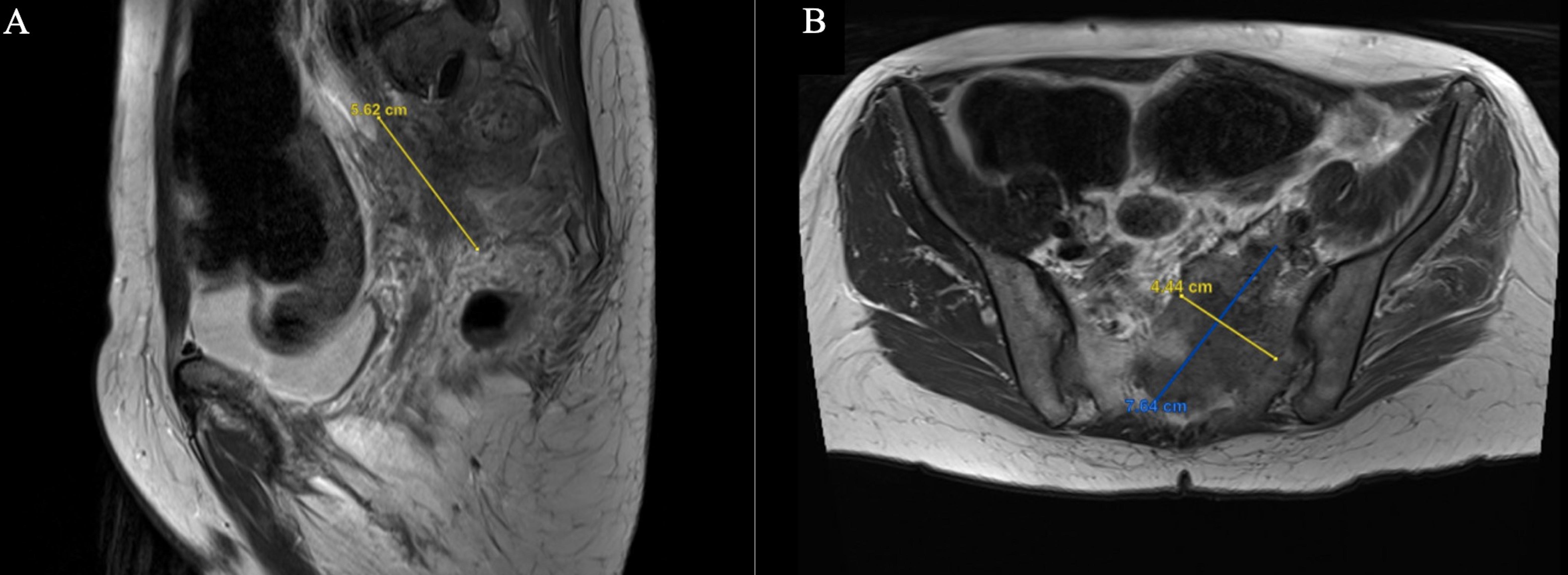 Urgent spinal MRI upon initial presentation to the emergency
department. (A) Sagittal view of pelvic MRI demonstrating a 5.6 cm pelvic mass
adjacent to the left hemisacrum. (B) Axial view of pelvic MRI with additional
dimensions of pre-sacral mass at 4.4 cm and 7.6 cm in maximal diameter.