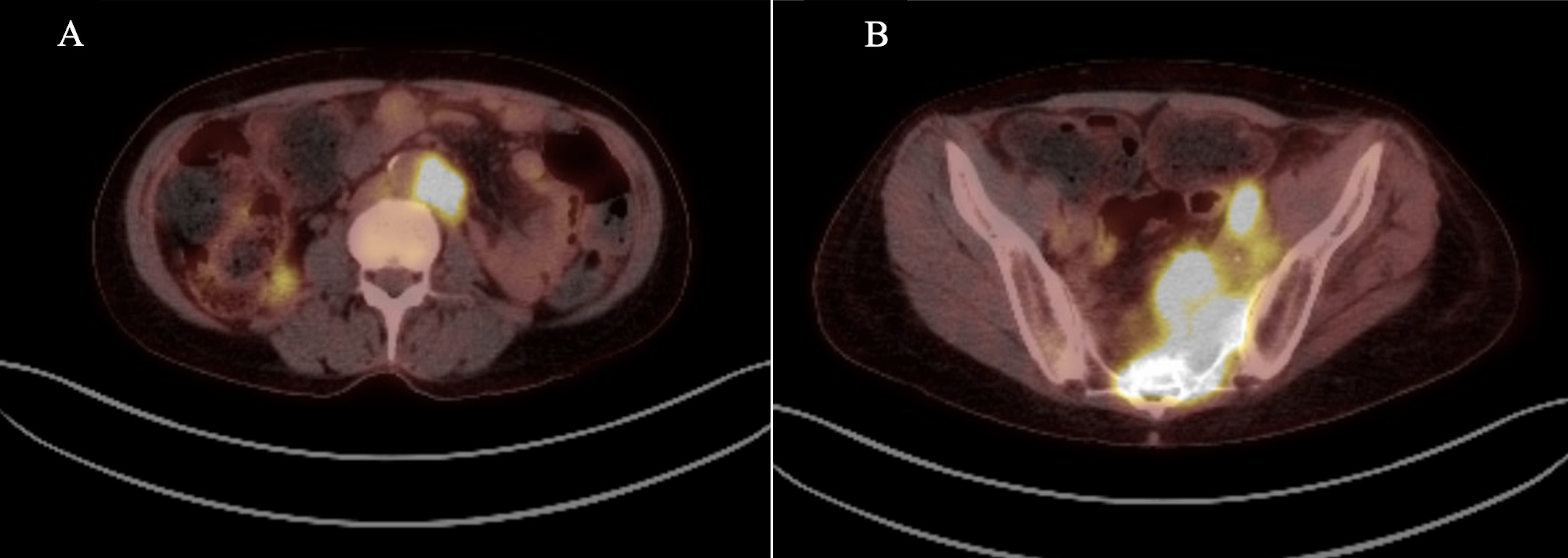Initial Positron-Emission-Tomography (PET) scan showing
fluorodeoxyglucose avidity. (A) Clear FDG avidity at the level of the
para-aortic lymph nodes. (B) FDG avidity in the left-hemi pelvis correlating to
pelvic mass as well as pelvic lymph nodes seen on CT and MRI scans.