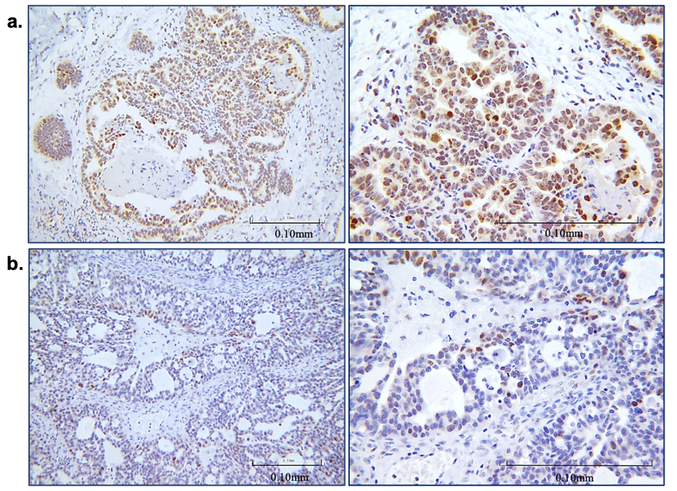 Smad2 phosphorylation. Representative 
immunohistochemistry pictures showing high (panel a) and low (panel b) P-Smad2 
expression in the examined series (magnification 20× and 
40×).