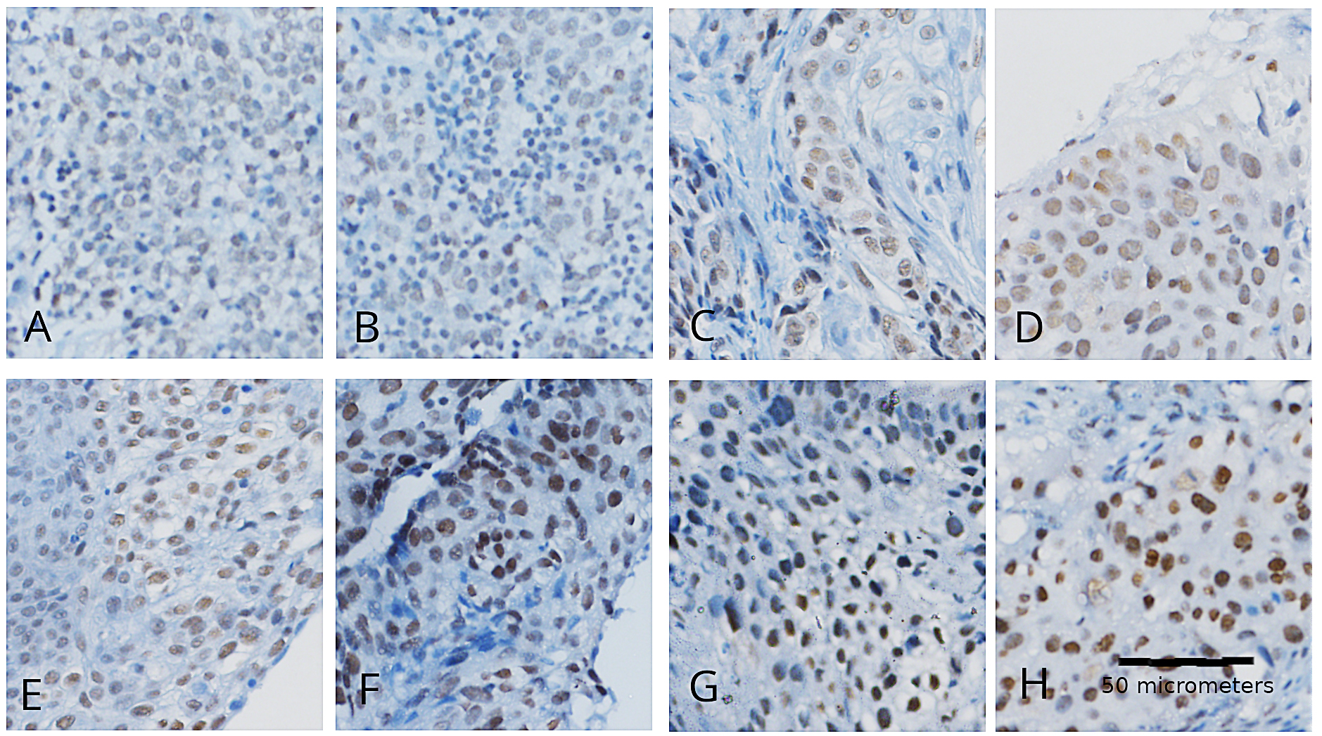 Staining intensity. (A) Squamous cell carcinoma with negative
FUS staining (20×). (B) Nests of neoplastic cells exhibiting weak
nuclear FUS staining and less than 50% of positive cells. (C) Nests of
neoplastic cells exhibiting weak nuclear FUS staining and between 50–75% of
positive cells. (D) Nests of neoplastic cells exhibiting weak nuclear FUS
staining and more than 90% of positive cells. (E) Nests of neoplastic cells
exhibiting moderate nuclear FUS staining and between 50–75% of positive cells.
(F) Nests of neoplastic cells exhibiting moderate and difuse nuclear FUS
expression. (G) Nests of neoplastic cells exhibiting strong nuclear FUS staining
and between 50–75% of positive cells. (H) Nests of neoplastic cells exhibiting
strong and diffuse nuclear FUS expression.