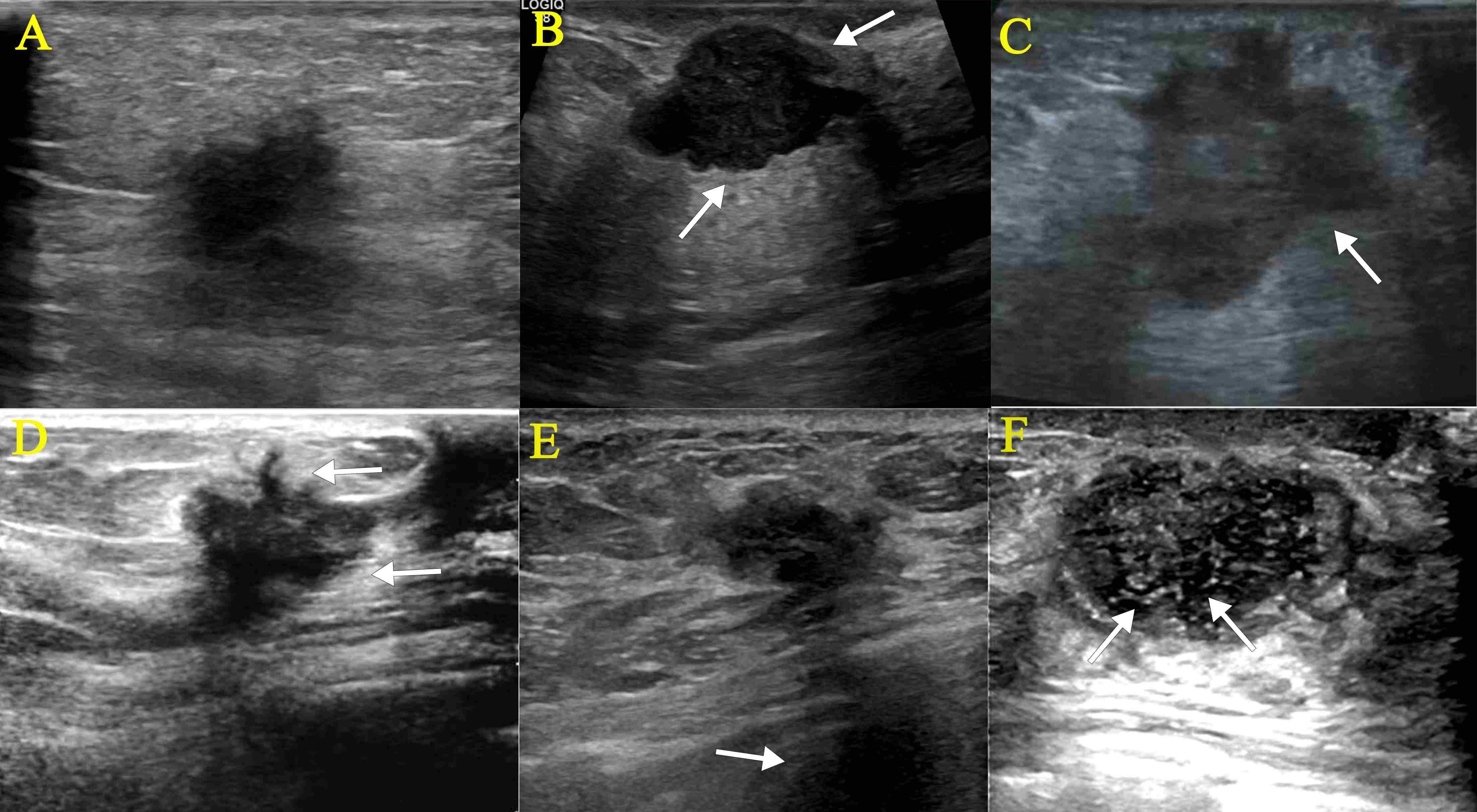 Representative ultrasound images illustrating different tumor
margin characteristics and acoustic features in breast cancer (BC) patients. The
arrows indicate (A) indistinct margin, (B) microlobulated margin, (C) angular
margin, (D) spiculated margin, (E) posterior shadowing and (F)
microcalcifications.