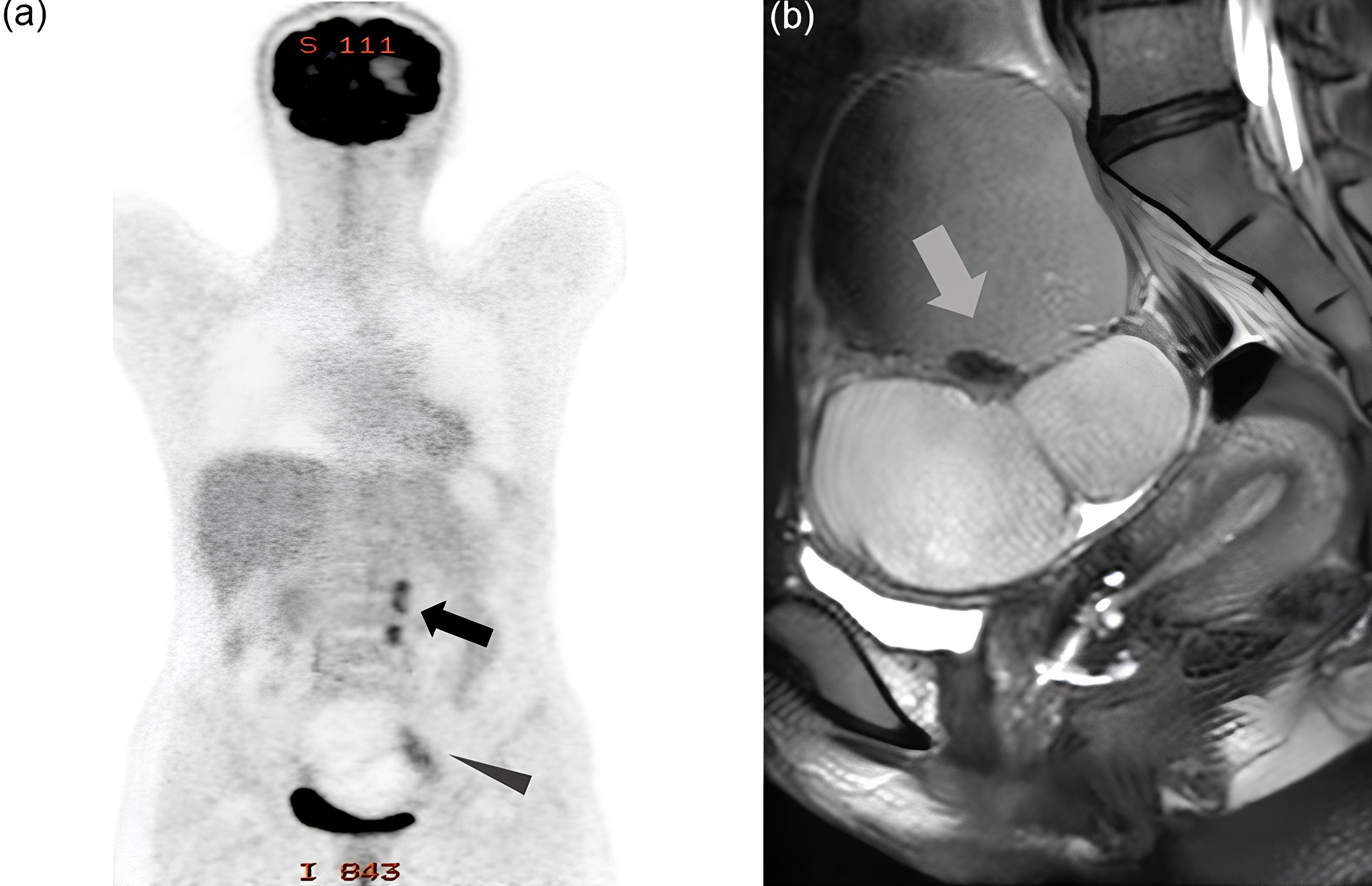 Medical imaging. (a) Accumulation observed in the para-aortic 
lymph node (←) and the left ovarian tumor (◄). (b) Contrast-enhanced 
magnetic resonance imaging (T2-weighted imaging): The left ovarian tumor shows 
liquid components, including fat and hemorrhagic areas, with suspected nodular 
components (←), indicating possible malignant transformation.