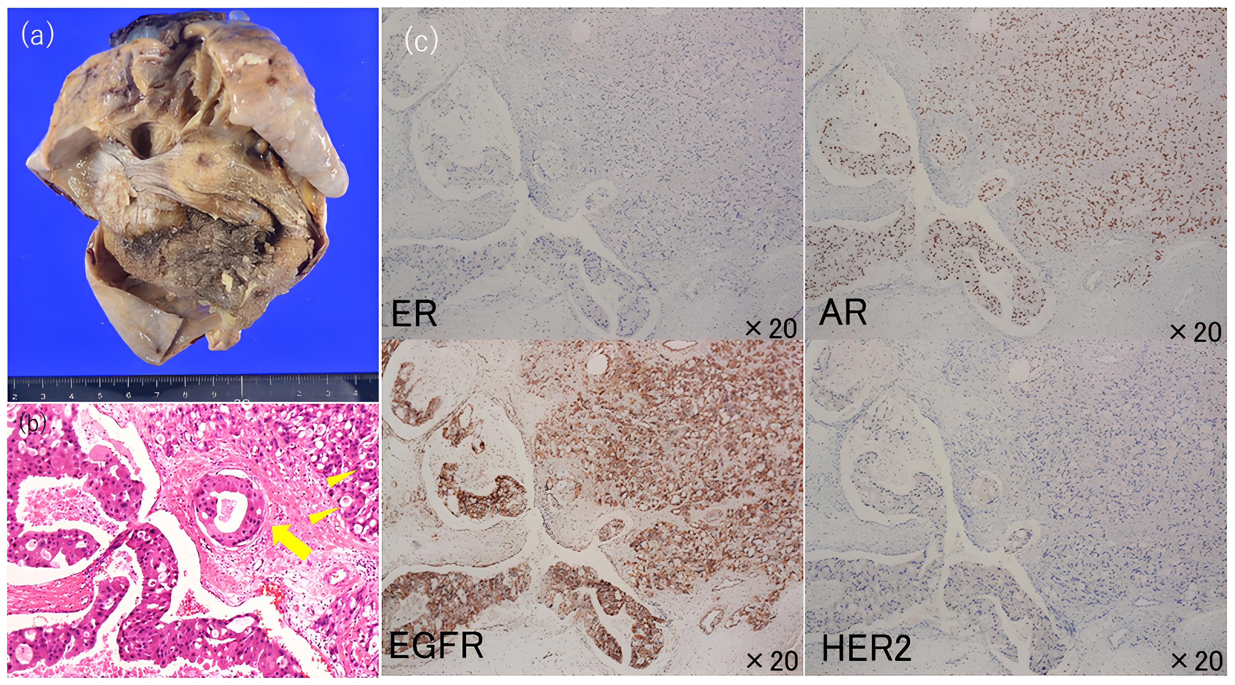 Pathological findings. (a) The tumor, approximately the size of 
a child’s head, contains fat, bone and hair components. (b) Hematoxylin and 
eosin staining (×20 magnification): Adenocarcinoma with abundant 
eosinophilic cytoplasm is observed, depicting fence-like proliferation within 
fibrous connective tissue. Tumor cells exhibit cytoplasmic vacuoles (◄), and 
decapitation secretion is noted within the glandular lumen (←). (c) 
Immunohistochemical staining reveals that the tumor is ER-negative, AR-positive, 
EGFR-positive and HER2-negative. ER: Estrogen receptor; AR: Androgen receptor; 
EGFR: Epidermal growth factor receptor; HER2: Human epidermal growth receptor 
type2.