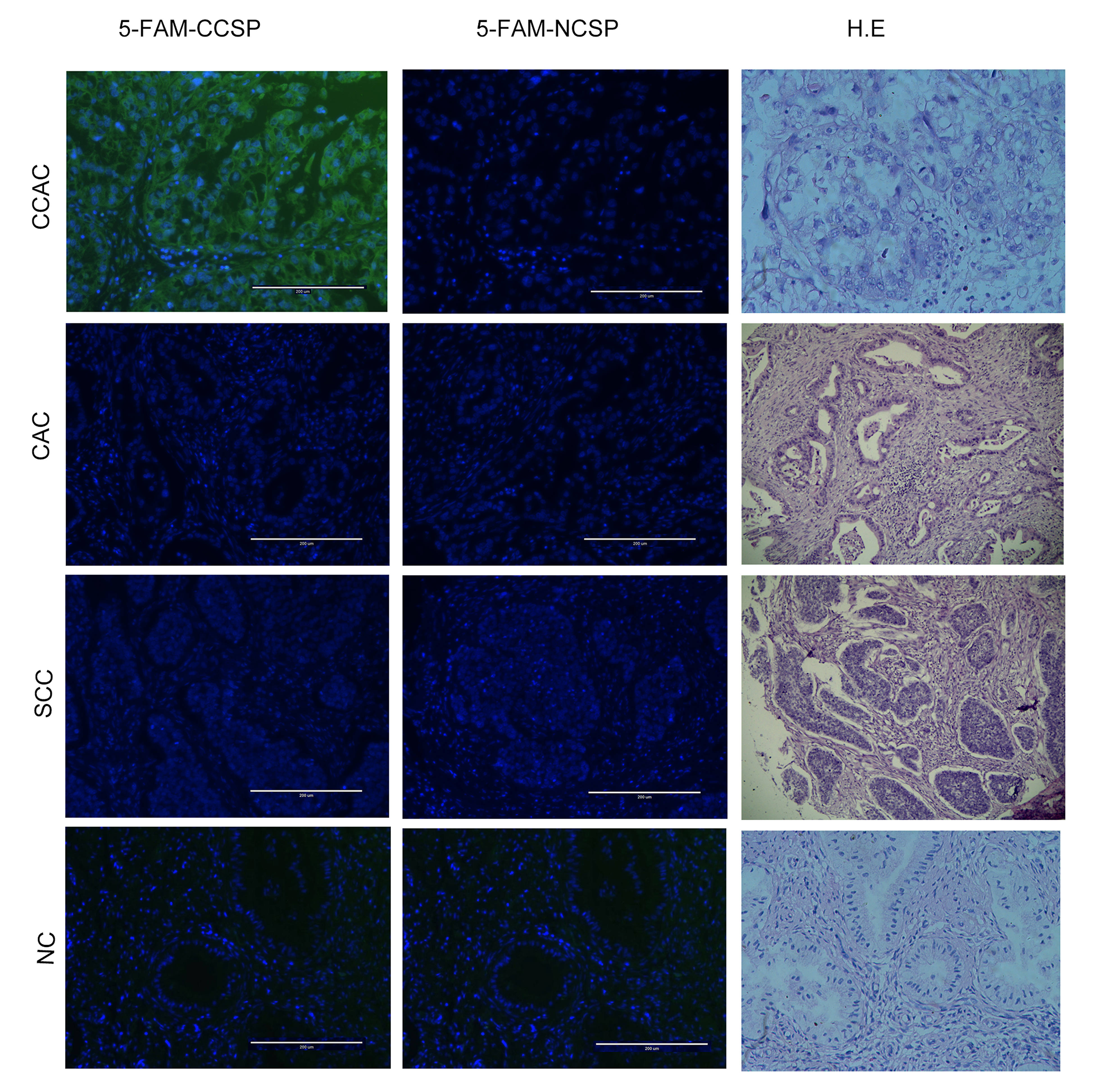 Specific binding of 5-FAM-CCSP (5-Carboxyfluorescein cervical
cancer specifically targeting peptide) to cervical cancer tissues, as
demonstrated by immunofluorescent histochemical staining (magnification
200×). Strong green fluorescence was considered a positive result.
Robust green fluorescence was observed from the cell membrane and cytoplasm of
CCAC (cervical clear cell adenocarcinoma) tissue cells. Conversely, minimal
fluorescence was detected in CAC (cervical adenocarcinoma), SCC (cervical
squamous cell carcinomas), and NC (normal cervical) tissues. Cervical tissues
treated with 5-FAM-NCSP (negative control peptides labeled with 5-FAM) exhibited
no fluorescence.
