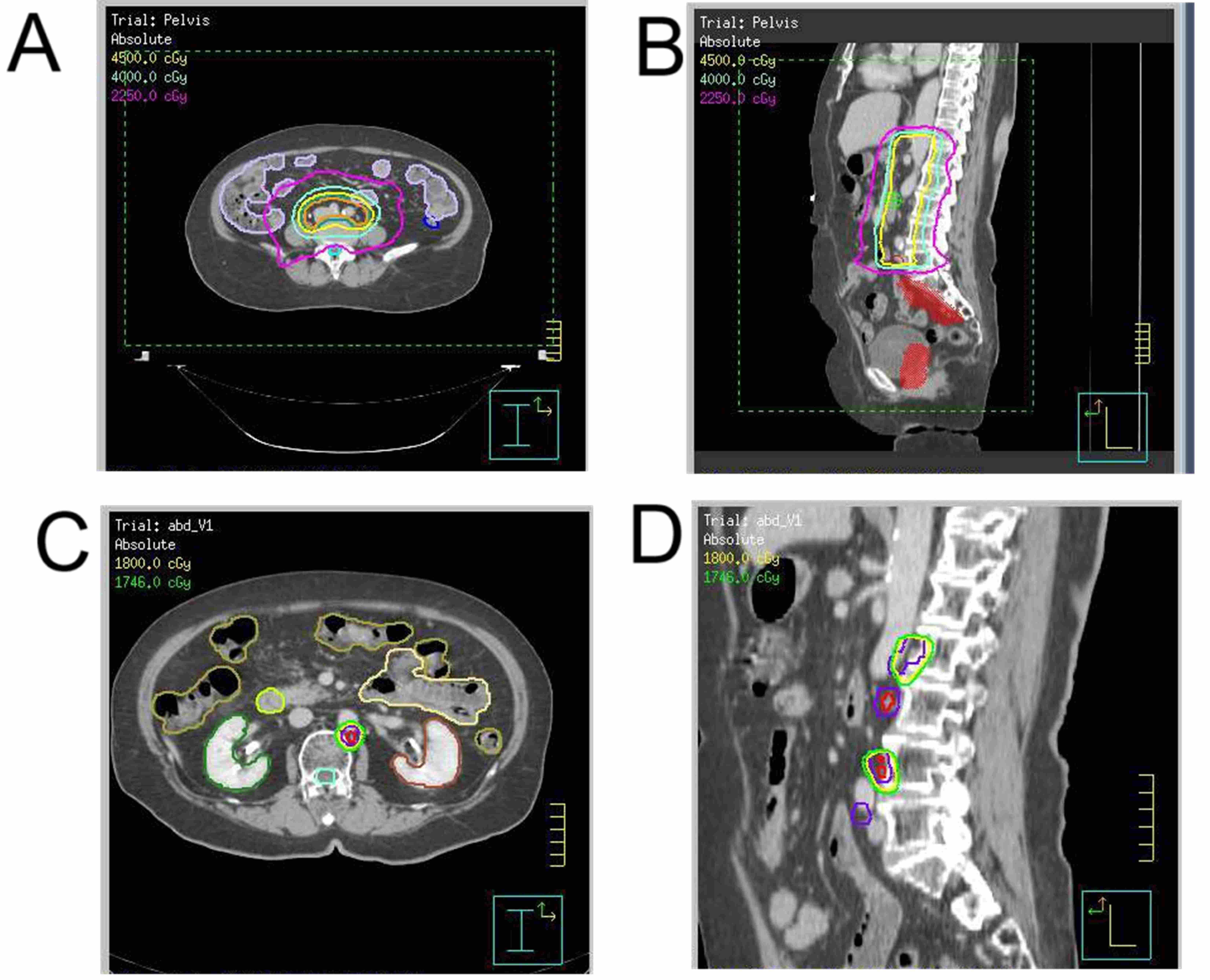 Dose distributions of Volumetric Modulated Arc Therapy (VMAT)
for radiotherapy targeting para-aortic lymph nodes are shown in axial (A) and
sagittal (B) views. The isodose lines for 45 Gy (yellow), 40 Gy (green) and 22.5
Gy (purple) are highlighted. The red coloured area in image B shows previously
irradiated pelvic disease. Additionally, the isodose lines for the boost dose of
18 Gy (yellow) are displayed in axial (C) and sagittal (D) views. Isodose lines
near the target shows organs at risk-bowel (yellow), left kidney (red) and right
kidney (green).