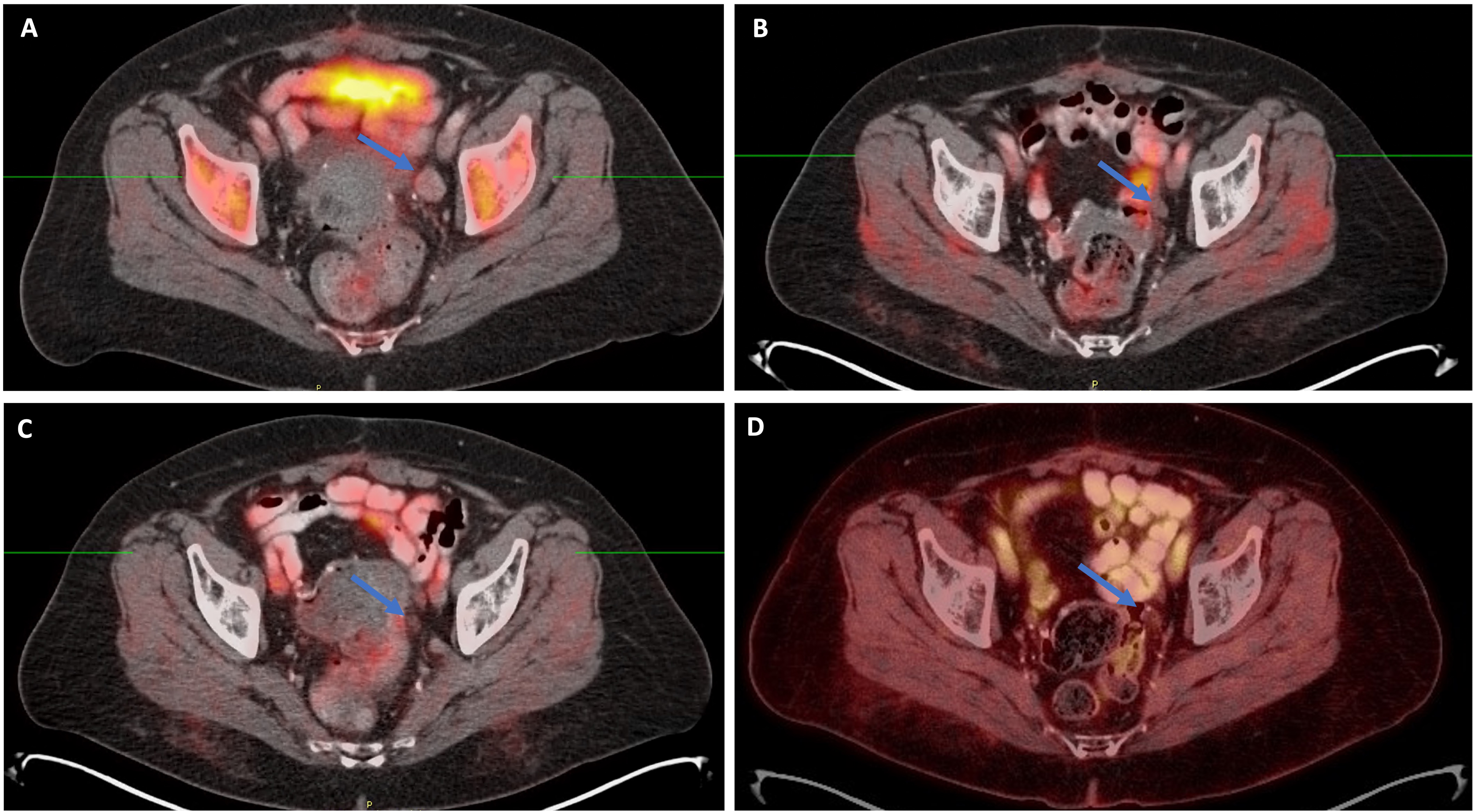 Imaging response to treatment (combination of local
radiation and CDK4/6 inhibitor with fulvestrant) in Patient 1 on serial positron
emission tomography/computed tomography (PET/CT) scans. (A) Baseline (prior to
treatment): Enlarged lymph node is present in the left pelvic side wall (arrow).
(B) First scan at three months post treatment: interval decrease in size of lymph
node (now 5 mm) in the left pelvic side wall (arrow). (C) 17-month follow up:
Interval decrease in size of lymph node (now non measurable) with focal
calcification in the left pelvic side wall (arrow). (D) Four-year follow up:
Stable non measurable lymph node with focal calcification in the left pelvic side
wall (arrow).